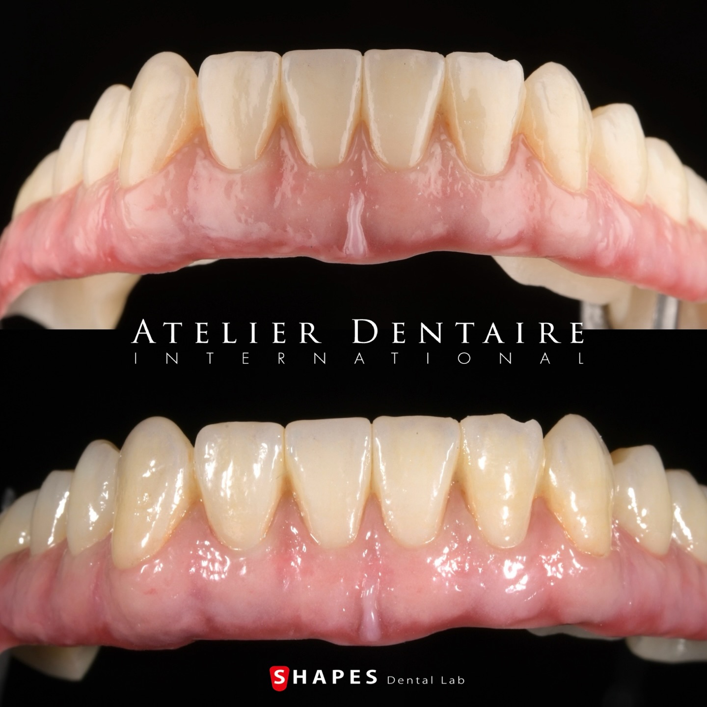 They look completely different, right?
I like both of them 😊
Thanks to you, @szabi.hant from the Atelier team, I was able to take this photo 🤝
・
・
・
・
@ivoclar
@uncsea
@atelierdentaire.international
@szabi.hant
#fullarch
#zirconia
#gum
#dentallab #dentallaboratory #aestheticdentistry #morphology #frontteeth #smile #dentaltechnology #zahntechnik #stomatolog #odontologo #dentalveneers #fullmouthrehabilitation #dentalphotography #dentaltechnician #dentistry#shofudental #shofuvintage #shofuvintageartuniversal