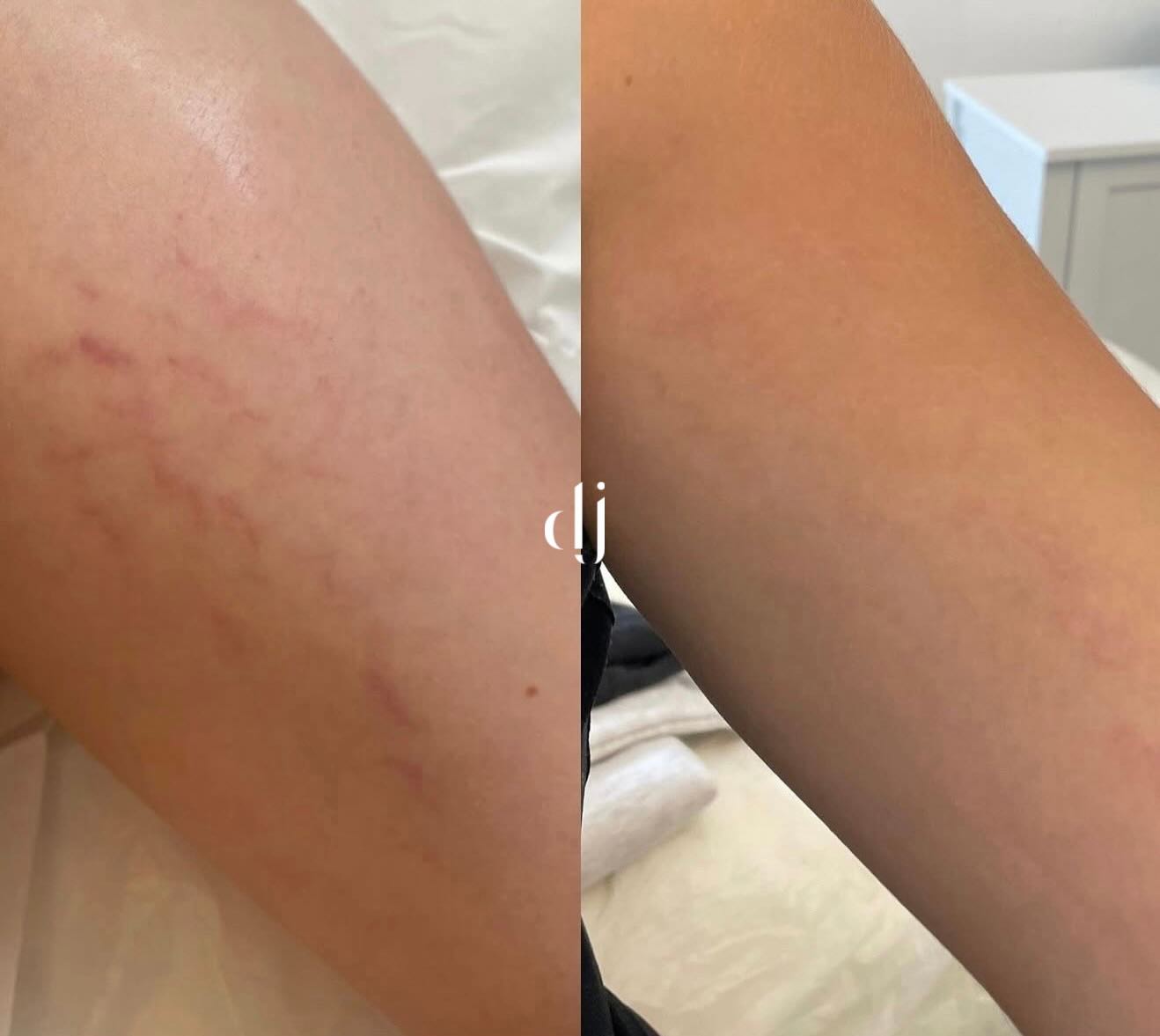 Medical Inkless Needling and scar camouflage tattoo
𝐖𝐡𝐞𝐧 𝐭𝐡𝐞 𝐛𝐞𝐟𝐨𝐫𝐞 & 𝐚𝐟𝐭𝐞𝐫𝐬 𝐬𝐩𝐞𝐚𝐤 𝐟𝐨𝐫 𝐭𝐡𝐞𝐦𝐬𝐞𝐥𝐯𝐞𝐬
Needling sessions 6 weeks apart with bespoke home care followed by a medical pmu skin camouflage session and review
Book your consultation today
#scarcamouflage #pmu #permanentmakeup #medicaltattoo #inklesstattoo