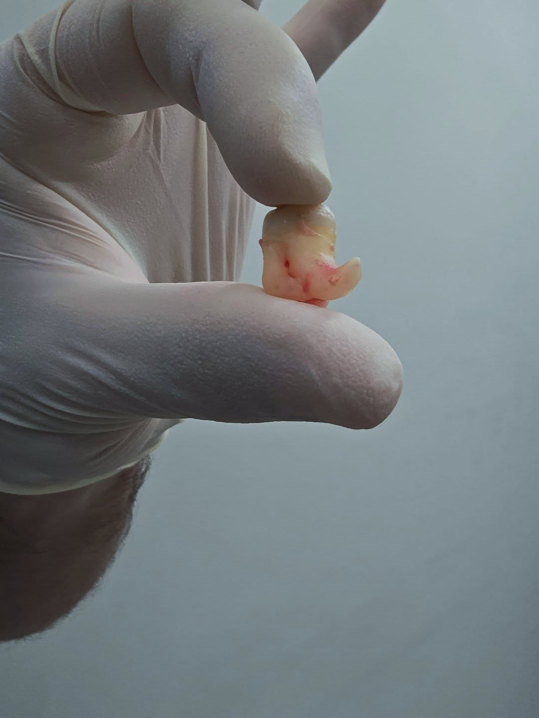 🦷 Chirurgia orale: estrazione complessa di un dente del giudizio con radici ricurve e in prossimità del nervo mentoniero.
👨🏻⚕️ Well done, dott. @mattia.todaro (chirurgo maxillo-facciale)
Dental Aesthetica
📍 viale della Grande Muraglia 256, zona EUR-Torrino
📱 375 88 47 069
#chirurgia #dentista #salute