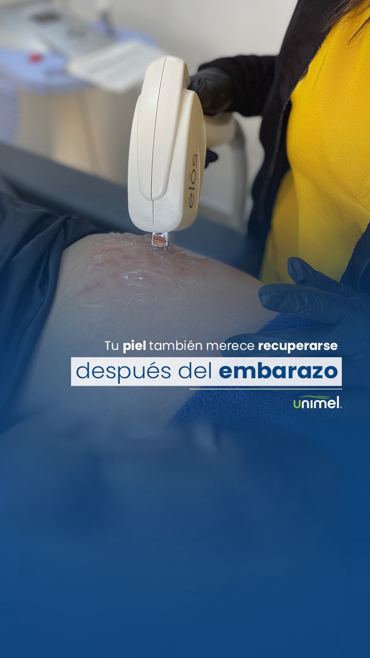 El embarazo trae cambios importantes en la piel, y entre ellos pueden aparecer estrías que afectan cómo te sientes con tu cuerpo.
La buena noticia es que hoy existen tratamientos médicos que mejoran su color, textura y profundidad, ayudando a que la piel recupere firmeza y uniformidad.
Cada caso es diferente, y por eso la evaluación es clave para elegir la mejor combinación de láser, bioestimuladores o técnicas regenerativas. ✨
#EstríasPostparto #PielReal #CuidadoCorporal #MedicinaEstética #Unimel