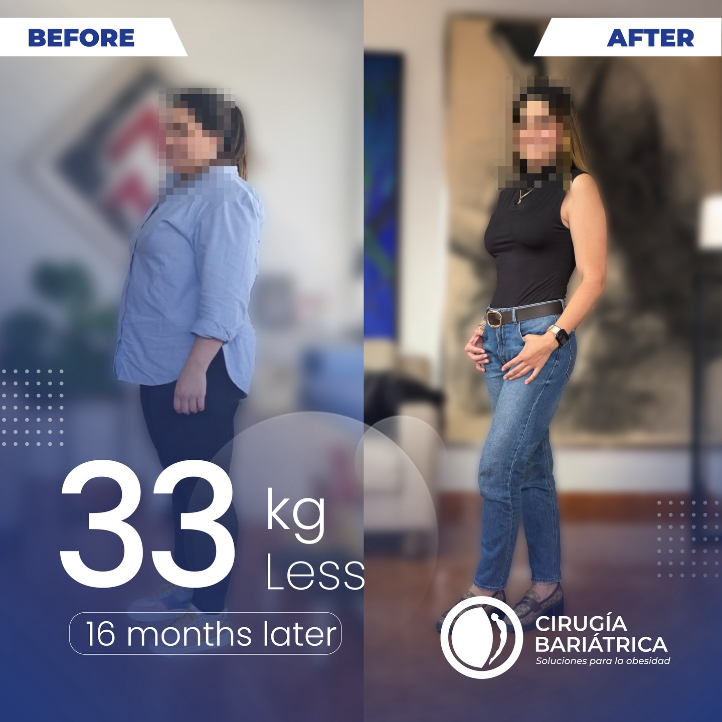 33 kilos menos en 16 meses y una vida completamente nueva.
Gracias a la cirugía bariátrica del Dr. Bolaños y su equipo de especialistas, hoy esta paciente sonríe con más salud, energía y bienestar.
Un proceso lleno de disciplina, acompañamiento y resultados reales que transforman vidas. 💙✨
73 pounds down in 16 months and a completely renewed life.
Thanks to the bariatric surgery performed by Dr. Bolaños and his team of specialists, this patient now shines with better health, energy, and well-being.
A journey of discipline, support, and real results that truly transform lives. 💙✨
#health #healthy #healthandwellness #weightlosssurgery #weightlossjourney