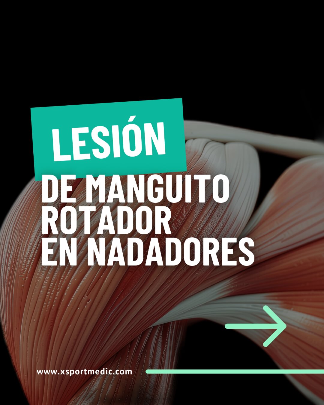 🏊♂️ El manguito rotador es una de las zonas que más se lesionan en natación por el esfuerzo repetitivo del hombro.
Conocer su anatomía, las lesiones más comunes y cómo prevenirlas puede marcar la diferencia en tu rendimiento y salud.
✔️ Prevención
✔️ Fortalecimiento
✔️ Recuperación segura
Cuidar tus hombros es clave para seguir nadando sin dolor.
Este es un post informativo: si tenés molestias, consultá a un profesional de salud.
www.xsportmedic.com