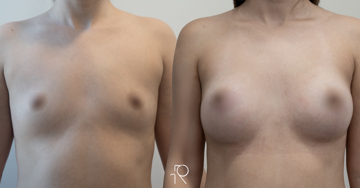 Seis meses de evolución de aumento mamario con tecnia dual plane. Como siempre aqui somos fieles a la armonia y naturalidad de los resultados ✨
• Las imágenes pueden haber sido editadas para ocultar elementos fácilmente identificables, con el fin de proteger la identidad y privacidad del paciente.