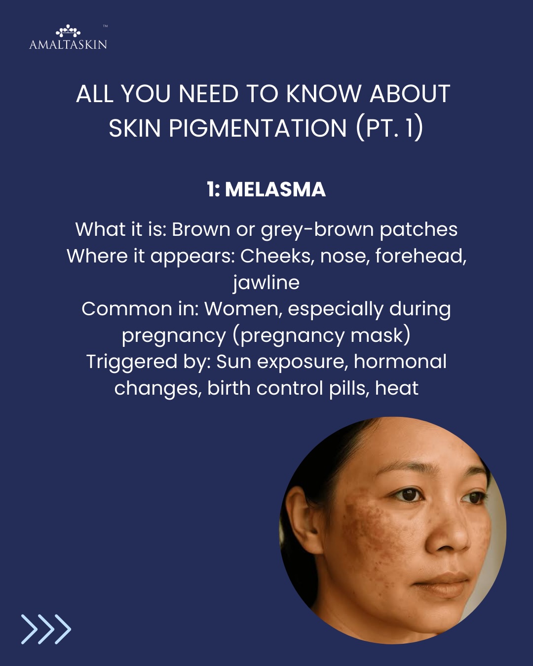Skin pigmentation isn’t “one issue” - it’s a spectrum of conditions caused by sun exposure, hormones, inflammation and even genetics. 🧬
Here are the most common types you should know:
✨ Melasma – Hormone-driven brown patches on cheeks & forehead
✨ PIH – Dark marks left behind after acne or injuries
✨ Sunspots – Age-related spots caused by cumulative UV damage
✨ Freckles – Genetic, tiny brown spots that darken with sun
✨ Tanning – When the skin produces extra melanin as a defence
Find a product for your concern: 🔗 in bio.
#amltaskin #amaltas #pigmentation #pigmentationsolution #pigmentationremoval #pigmentationtreatment #skinpigmentation #pigmentationremovalcream #naturalskincare #skincareproductsthatwork