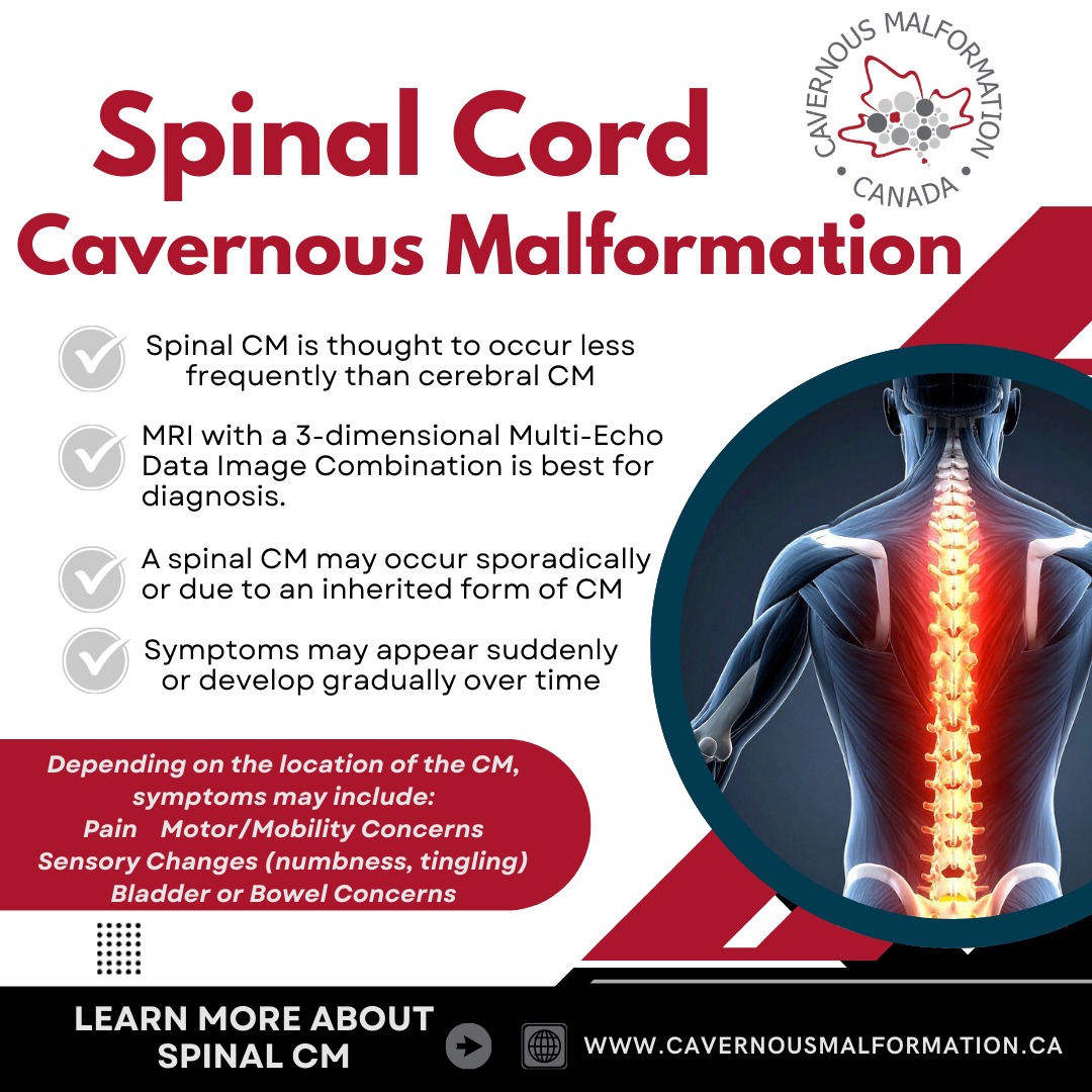 Cavernous Malformation can be found in the spinal cord. This is referred to as Spinal CM.
The spinal cord is a column of nerves that extends from the brain to your lower back. It consists of bundles of nerves that send incoming and outgoing messages between your brain and the rest of your body.
People with spinal CM may be asymptomatic or experience a range of symptoms, with many reporting more than one symptom.
Similar to cerebral CM, treatment choices are limited, with surgery or a watch and wait approach as the only options.
For more information about spinal CM, see the link in our bio or access the information on our website at www.cavernousmalformation.ca/spinal-cms
Une malformation caverneuse peut se développer dans la moelle épinière. On parle alors de malformation caverneuse spinale.
La moelle épinière est un faisceau de nerfs qui s'étend du cerveau jusqu'au bas du dos. Elle est constituée de faisceaux nerveux qui transmettent les messages entre le cerveau et le reste du corps.
Les personnes atteintes d'une malformation caverneuse spinale peuvent être asymptomatiques ou présenter divers symptômes, et beaucoup en rapportent plusieurs.
Comme pour la malformation caverneuse cérébrale, les options de traitement sont limitées : la chirurgie ou la surveillance active sont les seules possibilités.
Pour plus d'informations sur la malformation caverneuse spinale, consultez le lien dans notre bio ou rendez-vous sur notre site web : www.cavernousmalformation.ca/spinal-cms
#cavernousmalformation #spinalcm #spinalcavernoma #spinalcavernousmalformation #spinal #spinalcordinjury #cavernoma #weneedacure
