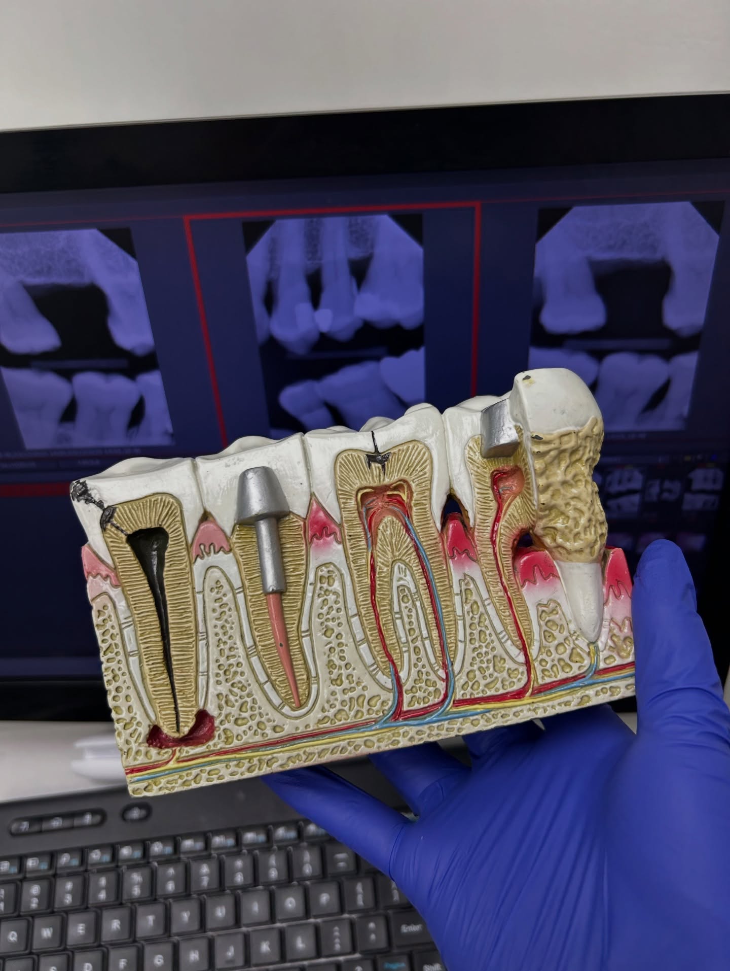 💡Understanding what happens beneath your gums is the first step toward a healthier smile! This model highlights gingivitis, bone loss, decay, root canals, and implants—common conditions we diagnose and treat every day. Sooo…
➡️ If you’re experiencing gum bleeding or tooth sensitivity, book an appointment with us and let us help you protect your oral health! 🦷💪
📞780.437.4000
#yegdental #hvdc #centurypark #dentalclinjc