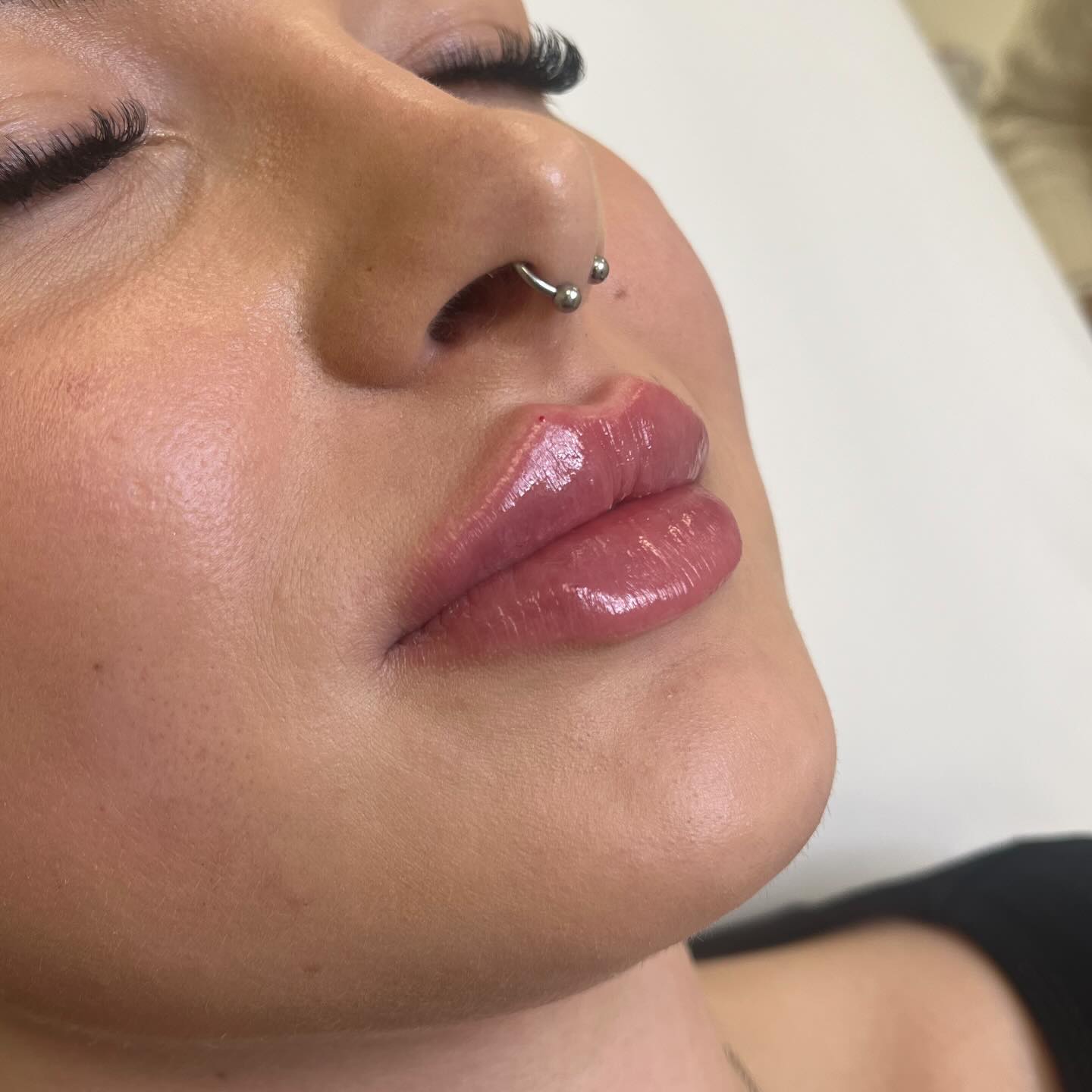 Lippenunterspritzung 💉 #lipsfillers #filler #beauty #bamberg #nürnberg