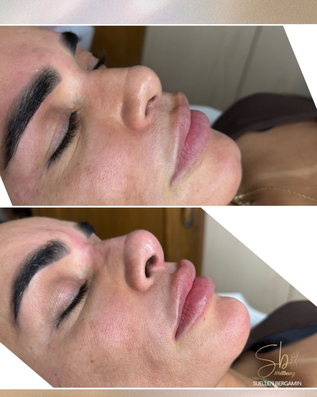 Quando essa cliente decidiu fazer perfiloplastia, o objetivo era claro: Realçar sua beleza de forma natural, elegante e totalmente personalizada.
E o resultado? Nariz, boca e queixo em perfeita harmonia. 😍🥰
A perfiloplastia é a combinação ideal para quem busca equilíbrio facial, definição e um perfil mais harmônico, tudo sem perder a naturalidade.
🌟 Nariz mais alinhado
🌟 Lábios proporcionais e delicadamente definidos
🌟 Contorno do queixo criando o equilíbrio perfeito
Pronta para realçar o melhor da sua versão também?
📲 Agende seu horário: +44 7398 192413
.
When this client decided to get a profiloplasty, the goal was clear: enhance her beauty in a natural, elegant, and completely personalized way.
And the result? Nose, lips, and chin in perfect harmony. 😍🥰
Profiloplasty is the ideal combination for those seeking facial balance, definition, and a more harmonious profile — all without losing naturality.
🌟 A more aligned nose
🌟 Proportional, softly defined lips
🌟 Chin contour creating the perfect balance
Ready to enhance the best version of yourself too?
📲 Book your appointment: +44 7398 192413