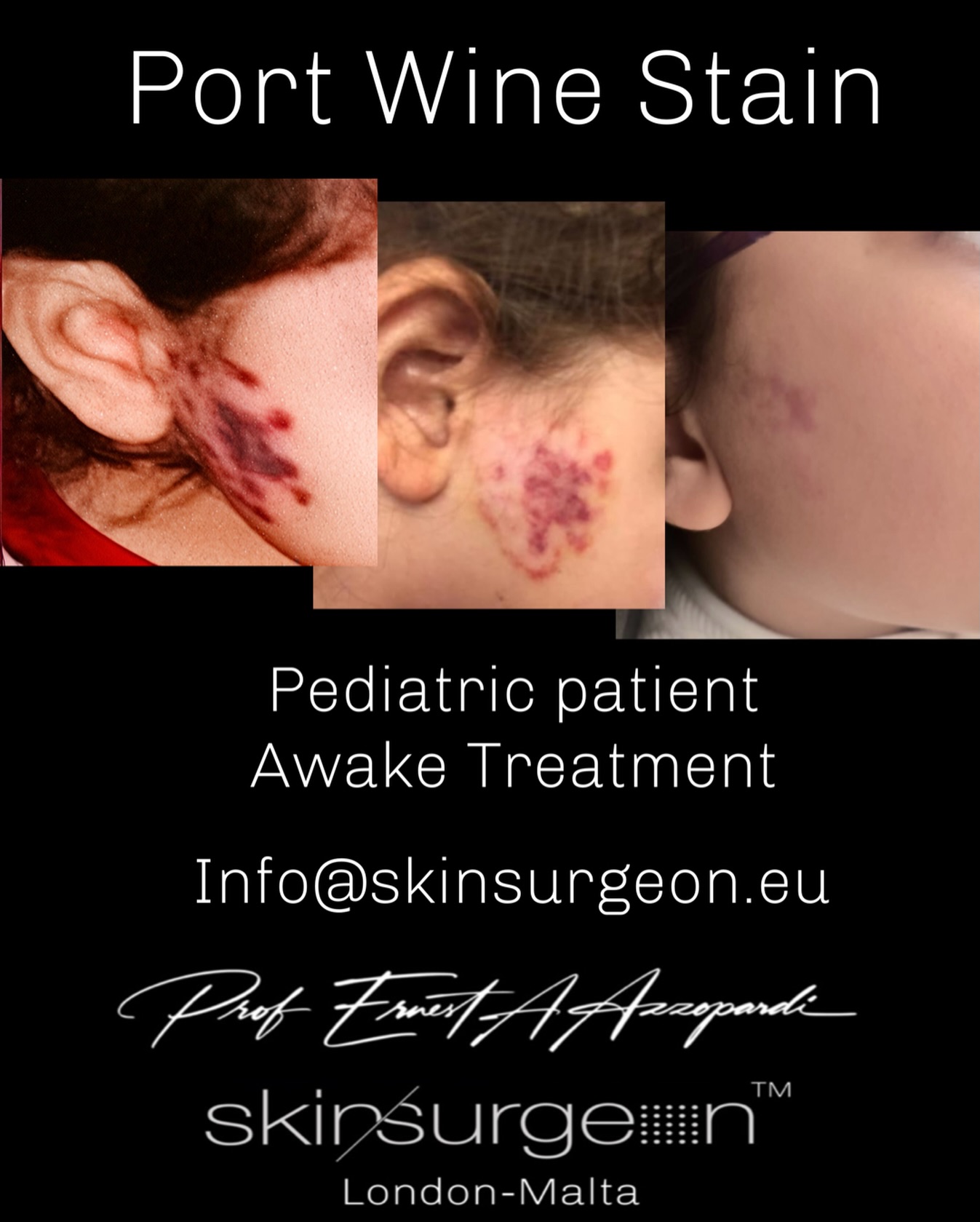 Successful treatment of a port-wine stain in a paediatric patient — fully awake, without the need for general anaesthesia.
This outcome reflects years of strategic investment in advanced laser platforms, de-risking protocols, and state-of-the-art pain-modulation technology, allowing us to deliver effective treatment while prioritising safety, comfort, and the child’s overall experience.
Reducing risk, avoiding unnecessary anaesthesia, and achieving meaningful clinical improvement is not incidental — it is the result of deliberate innovation and meticulous care.
#PortWineStain
#m22