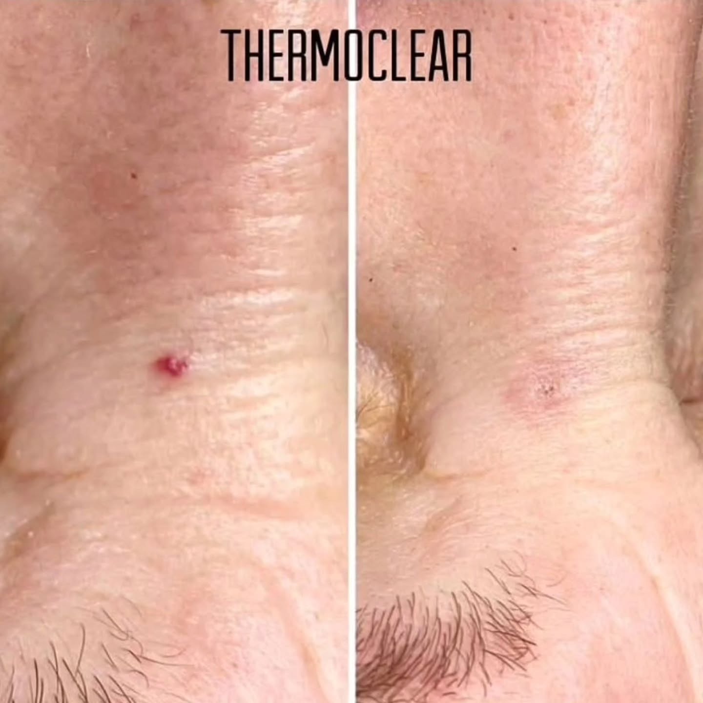 Wave goodbye to skin imperfections with ThermoClear USA! Our low and high radio frequency treatments offer fast results without the pain or downtime. 🚀✨ Link in Bio #SkincareRoutine #BeautyTech