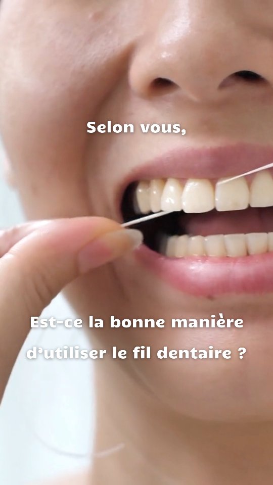 Alors vous en pensez quoi ?
Cette méthode peut faire saigner vos gencives ! 😬
Aller de bas en haut sans former le “C” autour de chaque dent n’enlève pas efficacement la plaque et peut blesser vos gencives.
Pour un nettoyage sûr et efficace :
1️⃣ Enroulez le fil autour de chaque dent en formant un C.
2️⃣ Faites un mouvement de va-et-vient doucement.
3️⃣ Ne forcez jamais entre les dents serrées.
L’intégrer dans votre routine, c’est des gencives plus saines, moins de plaque dentaire entre les dents ! ✨
.
.
.
#SantéDentaire #FilDentaire #Flossing #Gencives #Dentiste #Dentist #Cabinetdentaire #Luxembourg