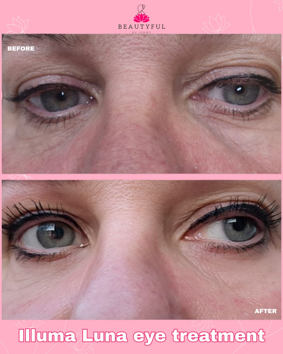 What did I get done to achieve this before and after?
๐๐ปIlluma Luna eye treatment
๐๐ป Polynucleotides
๐๐ป3 Peptides
๐๐ป Hyaluronic acid
If you saw my last video, youโll know how easy it is to apply these plus results can be seen immediately! This is the before and after on the same day, that I did on myself this week
Itโs such a wonderful Christmas present for anybody who is conscious of their eye area - or who was looking to get glowy radiant skin without the downtime
Contact me to book in for yourself or a loved one this Christmas ๐
also available in a voucher!