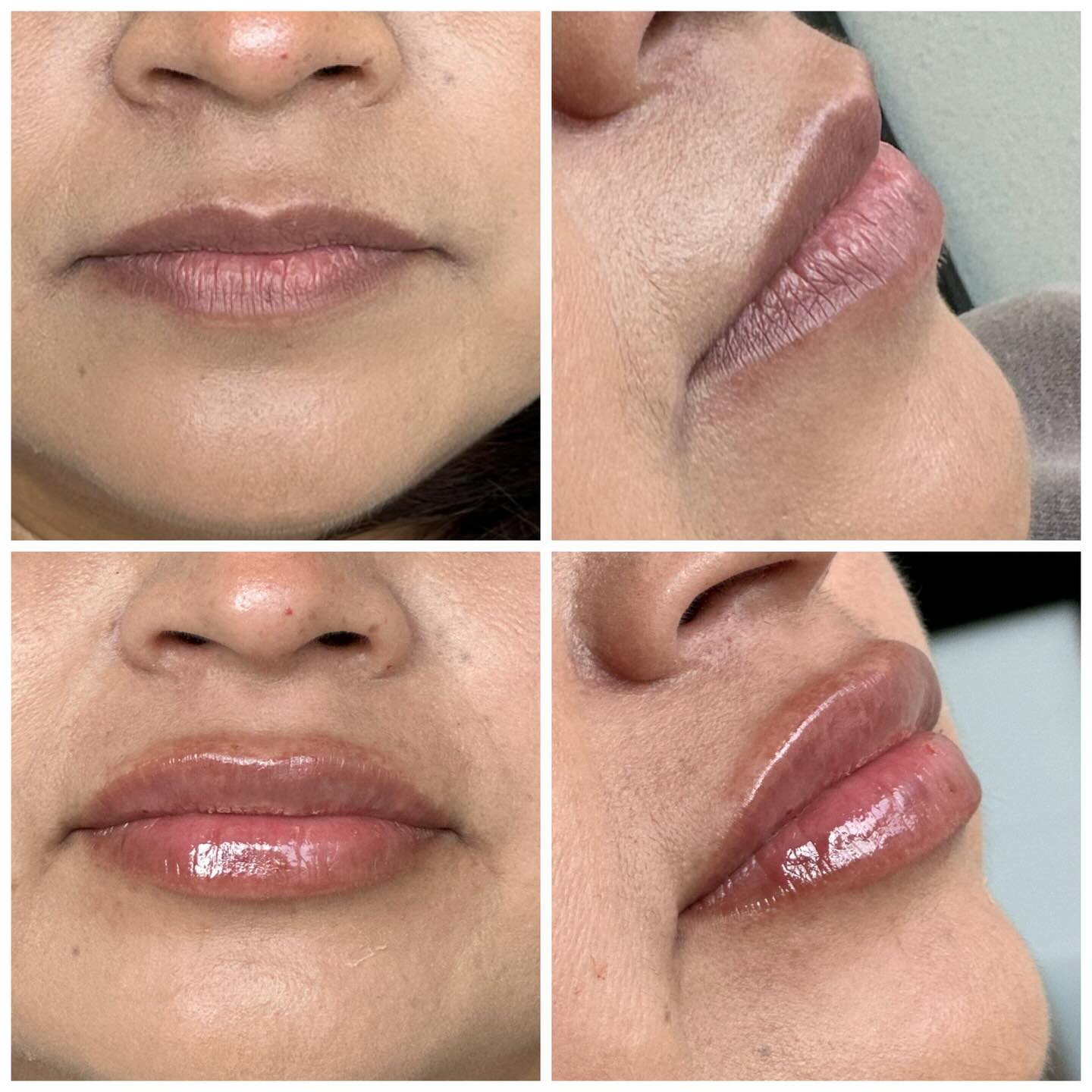 Don’t forget to treat yourself this holiday season and get those lips you’ve always wanted 🥰 🎄
Dm or 📲971-375-6381 to book
Manda mensaje o llama para agendar tu cita 📆
#lipfillers #keizer #revanesselips #medspas