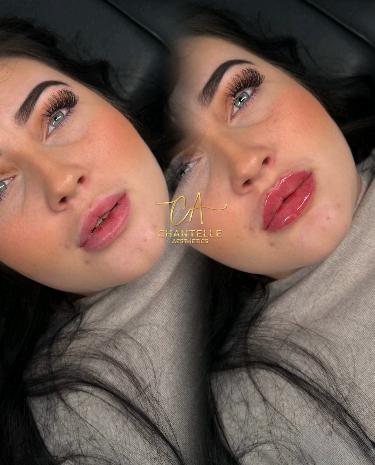 A handful of my favourite lip filler transformations over the past few weeks 😮💨😮💨