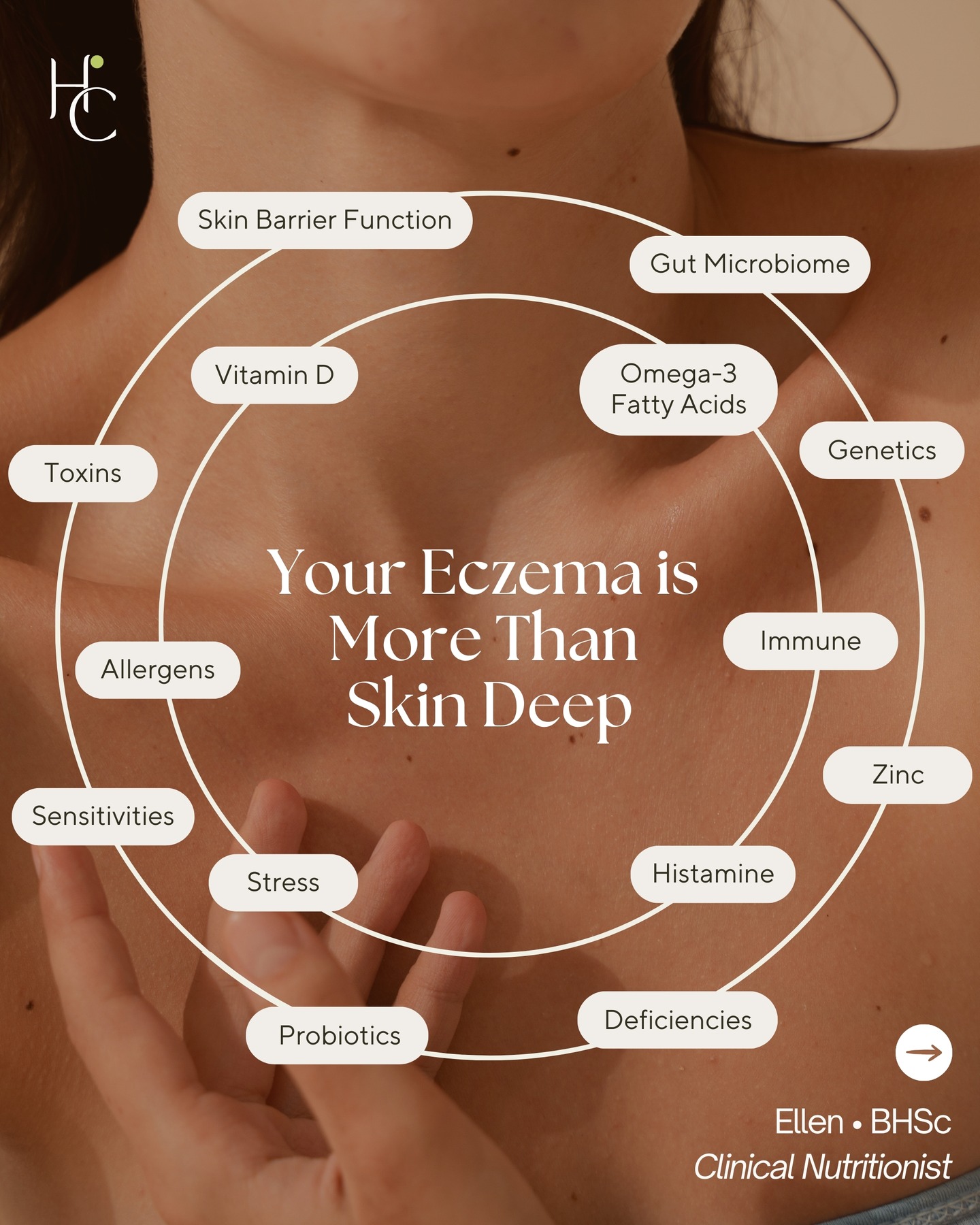 Your eczema is more than skin-deep.
As a Clinical Nutritionist (BHSc), I support eczema from both a clinical and lived perspective. I understand from my own experience how deeply it can affect daily life, especially through these warmer months of the year.
Together, we explore what may be driving symptoms beneath the surface of your skin, and map out a clear, evidence-informed nutritional plan with lifestyle strategies to support healing.
You’ll receive a personalised, science-backed plan following your Initial Consultation.
💌 DM me now for some more info or to find a time for a complementary 10 minute discovery call 💌
All my best,
Ellen
BHSc | Clinical Nutritionist