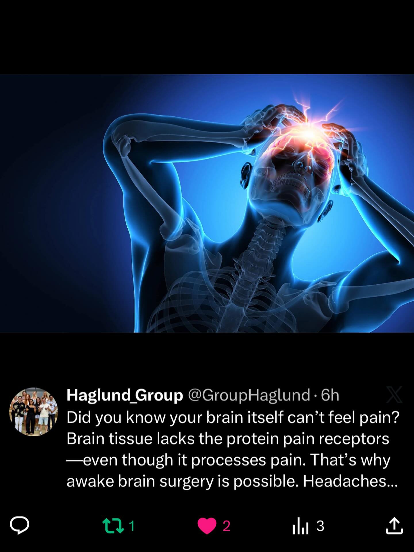 Did you know your brain itself can’t feel pain? Brain tissue lacks the protein pain receptors—even though it processes pain. That’s why awake brain surgery is possible. Headaches actually come from pain-sensitive tissues around the brain, like blood vessels, meninges, and muscles!!
#funfactfriday #funfacts