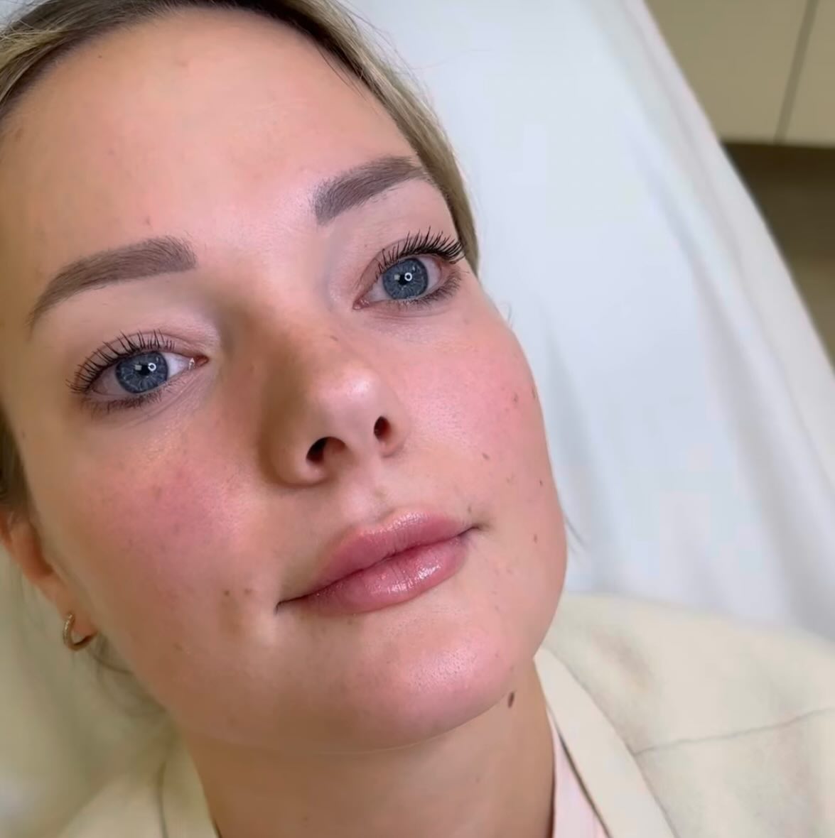 Natürliche Lippenunterspritzung 💉 #filler #beauty #lippen #bamberg #nürnberg