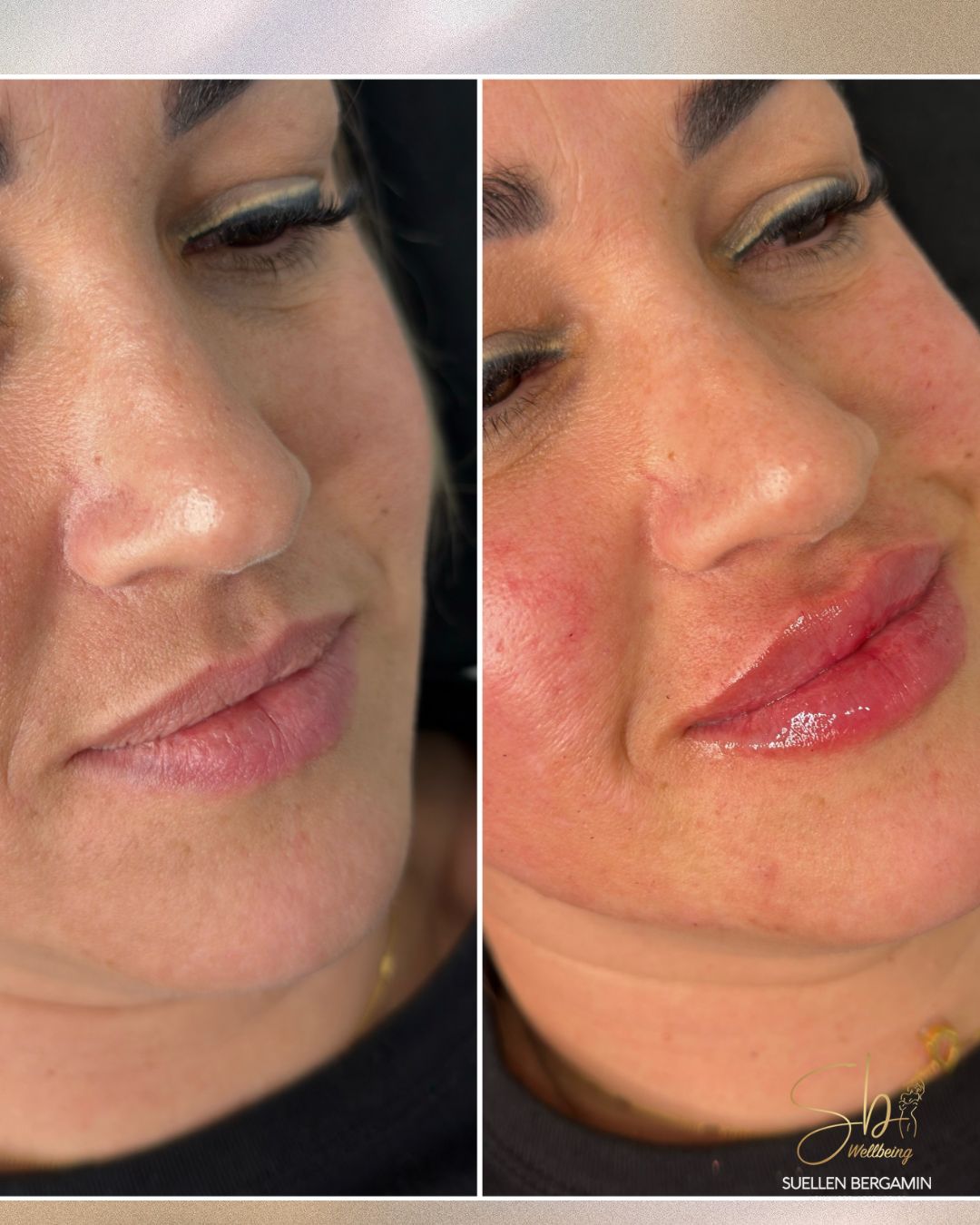 Um close nesse resultado que ficou divino!! 😍💋
Meninas, olhem esses lábios como ficaram mais definidos, harmônicos e com aquele volume na medida certa.
Exatamente como a cliente queria: Natural, mas aparente!
Quando o preenchimento é feito com técnica e sensibilidade, o resultado fica elegante e sem exageros.
Pronta para realçar ainda mais a sua beleza também?
Agende sua avaliação!
📲 +44 7398 192413
.
A close-up of this divine result!! 😍💋
Girls, look at how these lips turned out — more defined, more harmonious, and with just the right amount of volume.
Exactly what the client wanted: natural, yet noticeable!
When lip fillers are done with technique and sensitivity, the result is elegant and never overdone.
Ready to enhance your beauty too?
Book your consultation!
📲 +44 7398 192413