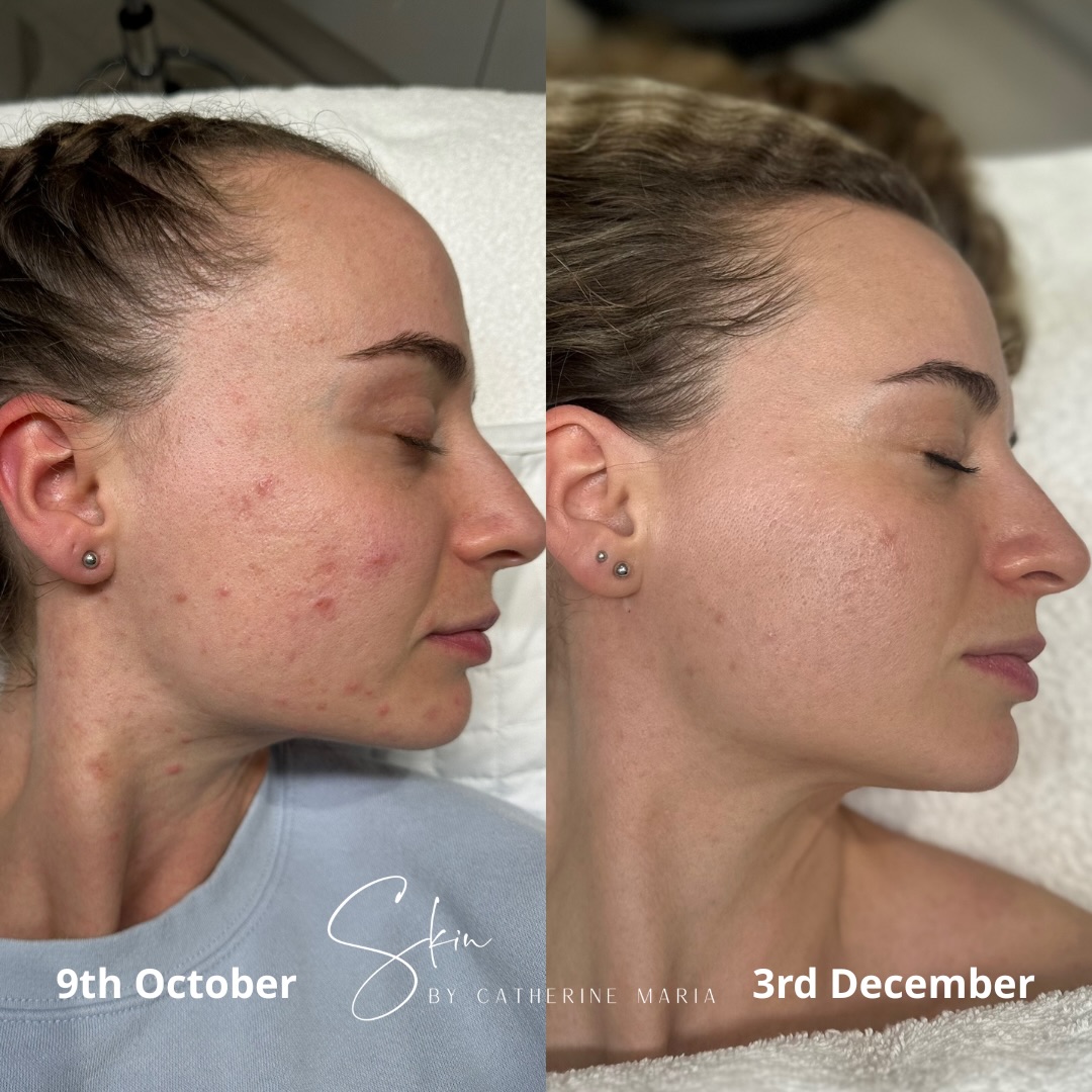 So proud of my client’s skin transformation 💕
My lovely client came to see me on the 9th of October for a full skin consultation. We spent time looking at everything that could be contributing to her symptoms including diet, lifestyle, medication, stress levels and her current routine.
She was tired of trying things that didn’t work, tired of harsh products that only made her skin feel worse, and tired of feeling like nothing was ever going to change.
She had been relying on harsh products in the past (witch hazel, fragrance, perfumed skincare), simply because they didn’t trigger ‘much’ breakouts. But they were quietly damaging her barrier, and occasionally having itchy, irritated eyes and inflammation around the face.
We took a gentle 360 approach.
• Calming and barrier-supporting skincare using @alumiermd_int
• Reducing whey protein (a better alternative is switching to pea protein powder)
• Increasing omega-3s and focusing on nutrient-dense meals
• Supporting her overall skin health from the inside out
Her progress in such a short time has been amazing.
We carried out her first @sqt_uk Nourish & Hydrate treatment on the 16th of October, and her second session yesterday (3rd December). Her skin has responded beautifully, much calmer, clearer and back in a state of balance.
I’m so proud of her, and so grateful she trusted me with her journey 🤍
📍 Aylesbury, Buckinghamshire
📞 07759567391
📩 info@skinbycatherinemaria.com
🌍 www.skinbycatherinemaria.com
#aylesbury #aylesburybusiness #aylesburyvale