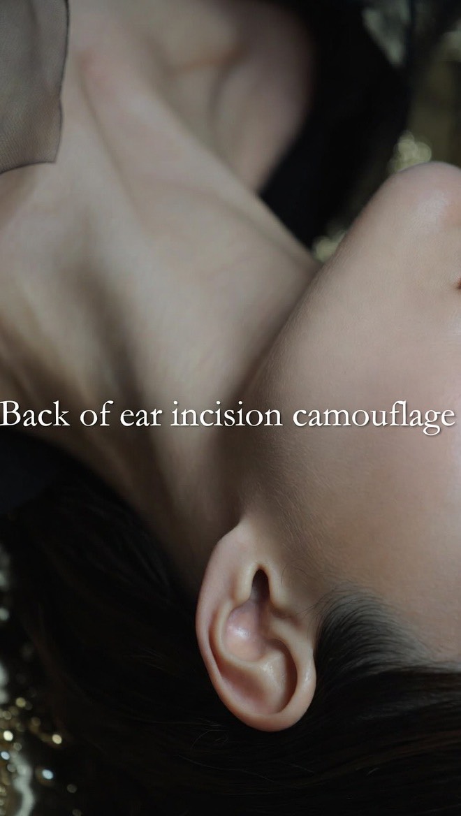 Back-of-Ear Facelift Scar Camouflage (Hypopigmented Scar Repair) ✨
If you’ve had a facelift, whether it was a deep plane facelift, SMAS facelift, mini facelift, or neck lift, the incision behind the ear can sometimes heal lighter than the rest of your skin. Many clients come to me with hypopigmented, bright-white scars that make them self-conscious—especially when wearing their hair up.
This client’s scar was extremely white and lightened from the loss of pigment after surgery. That’s where medical tattooing and scar camouflage tattooing make all the difference.
Using advanced scar camouflage, I slowly deposit custom-blended tones that match your exact skin color so the area looks like natural skin again—not “tattoo ink.”
This result is several sessions in and still blending, but you can already see how seamless the transition is becoming. When the process is complete, you won’t be able to tell where the incision line was. It will look like your own skin, not a tattoo.
If you’ve had:
• Deep plane facelift
• SMAS facelift
• Mini facelift
• Neck lift
• Lower facelift
• Temporal lift
…and you’re struggling with visible incision lines around the ear, especially if they healed white, silvery, or hypopigmented, scar camouflage can restore confidence without surgery.
My specialty is making facelift scars disappear naturally through the power of medical tattooing, so you can wear your hair up again without feeling self-conscious.
✨ Imagine You New – St. Petersburg, Florida
Scar Camouflage • Hypopigmentation Correction • Medical Tattooing
📞 727-729-9069
🌐 www.imagineyounew.com
For professional training in these techniques:
✨ International Institute of Medical Tattoo Science and Artistry
📞 727-504-4664
🌐 www.medtattooeducation.com
#DeepPlaneFacelift
#SMASFacelift
#MiniFacelift
#LowerFacelift
#MidFacelift
#NeckLift
#TemporalLift
#VerticalFacelift
#HighSMASFacelift
#scarcamouflage
#FaceliftIncision
#FaceliftScar
#tampaflorida
#stpetersburgflorida
#sarasotaflorida
#plasticsurgeon