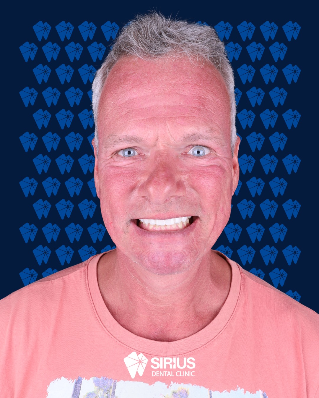 His fractured, uneven and periodontally compromised upper front teeth were completely restored through a personalised treatment plan. We achieved an upper arch that is both aesthetically pleasing and functionally ideal.
At his next appointment, we aim to complete the smile design with the planned lower arch treatments.
#siriusdental #smileturkey #zirconiumcrowns #smiledesign #antalyadentalclinic