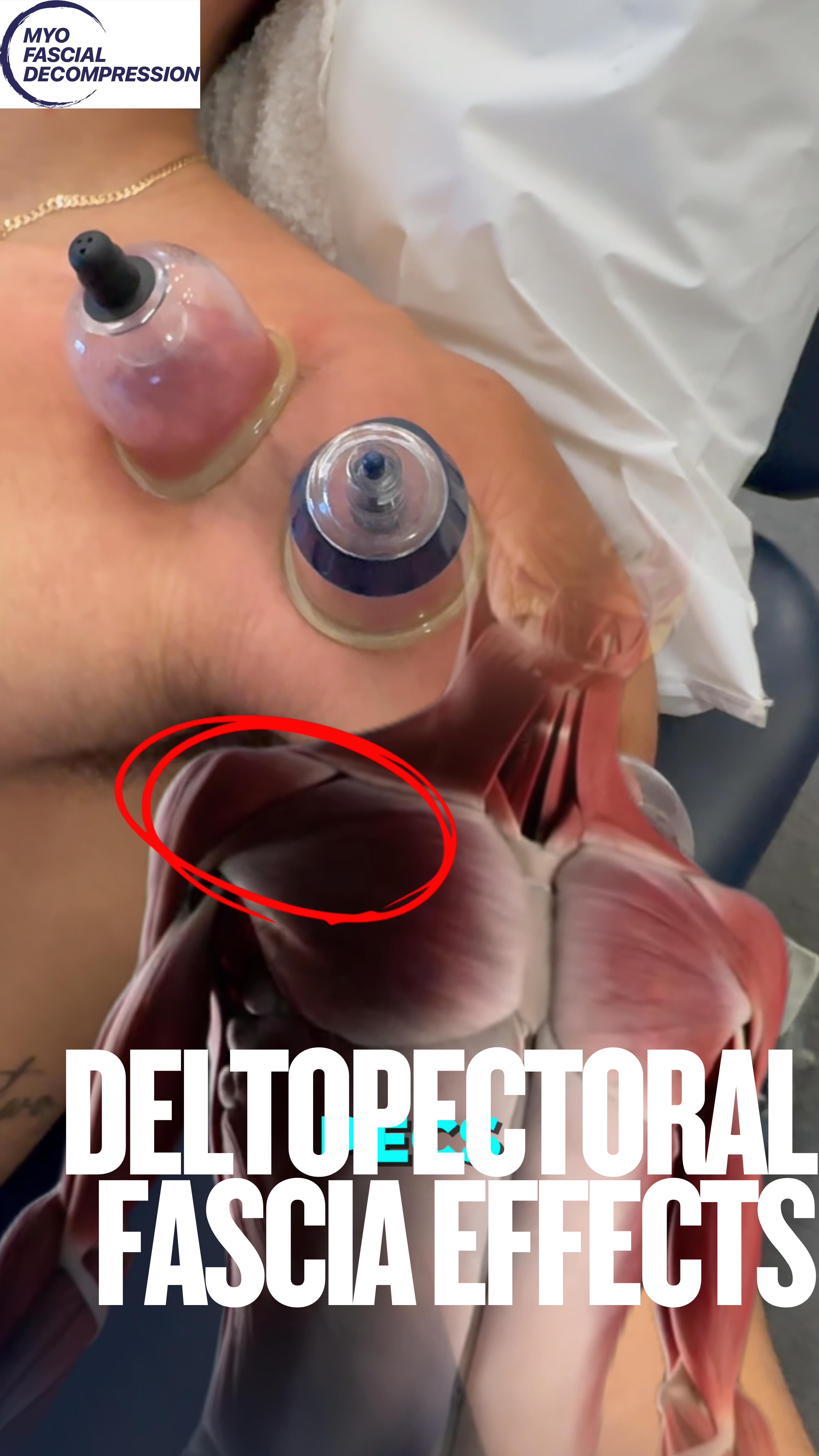 What is the deltopectoral fascia, and why does it matter so much for anterior translation of the humeral head? The term shoulder impingement may have fallen out of favor because of the mechanical nature of the rotator cuff tendons not being rubbed by the acromion the way we once thought, but it doesn’t mean the soft tissue structures aren’t sending signals of compression to the 🧠. This area is a gamechanger for the overhead athlete and swimmers! 💪🏽
#beyondcupping #myofascialdecompression #curvedcups