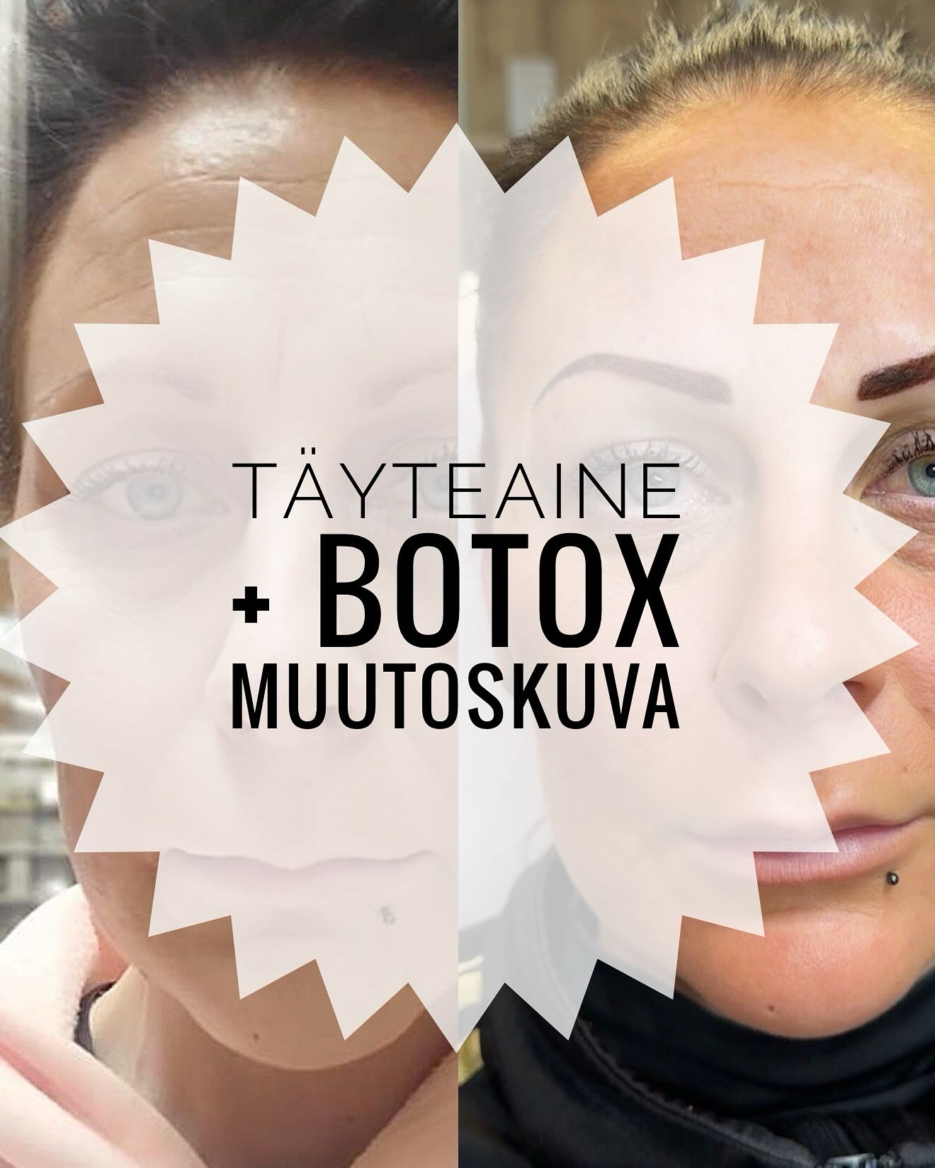 Huikea muutoskuva 👌Kuvien välillä muutama viikko.
Asiakkaalle laitettu täyteainetta poskiin, otsaan sibeliusjuonteeseen ja huuliin.
Lisäksi hoidettu otsaa,silmäkulmia ja huulen yläosaa botoxilla.
Lopuksi teimme vielä kulmien pigmentoinnin. 😍😍