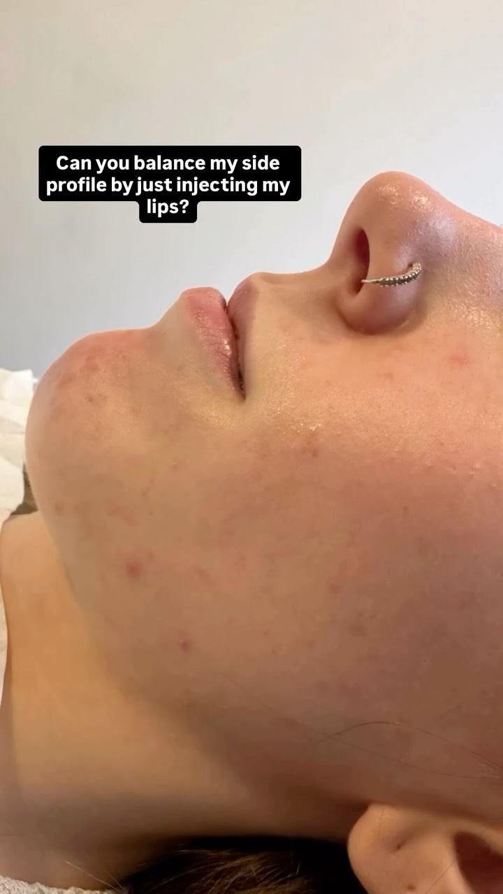 ✨ “Can you balance my side profile with just lip filler?”
Yes — and this reel shows exactly how strategic lip augmentation can subtly enhance projection, height, and overall definition to create a more harmonised side profile.
By carefully adding dermal filler to the lips, we can improve the balance between the nose, lips, and chin — achieving a more proportionate, natural, and aesthetically balanced look without treating any other area.
💋 Lip filler | Profile balancing | Dermal filler | Lip augmentation | Facial harmonisation | Non-surgical aesthetic treatment | Natural results ✨
𝖡𝗈𝗈𝗄𝗂𝗇𝗀𝗌
☏ 𝟢𝟩𝟦𝟫𝟪𝟫𝟪𝟩𝟣𝟪𝟪
☞︎ 𝗆𝗂𝖽𝗅𝖺𝗇𝖽𝖼𝗅𝗂𝗇𝗂𝖼𝗌@𝗀𝗆𝖺𝗂𝗅.𝖼𝗈𝗆
✩ 𝗐𝗐𝗐.𝗆𝗂𝖽𝗅𝖺𝗇𝖽𝖼𝗅𝗂𝗇𝗂𝖼.𝖼𝗈.𝗎𝗄
𝖬𝗂𝖽𝗅𝖺𝗇𝖽 𝖠𝖾𝗌𝗍𝗁𝖾𝗍𝗂𝖼𝗌 𝖢𝗅𝗂𝗇𝗂𝖼 𝖢𝗈𝗏𝖾𝗇𝗍𝗍𝗒
✩ 𝖬𝖾𝖽𝗂𝖼𝖺𝗅 𝖯𝗋𝖺𝖼𝗍𝗂𝗍𝗂𝗈𝗇𝖾𝗋 𝖫𝖾𝖽 𝖠𝖾𝗌𝗍𝗁𝖾𝗍𝗂𝖼𝗌
✩ 𝖥𝗎𝗅𝗅𝗒 𝖨𝗇𝗌𝗎𝗋𝖾𝖽 𝖢𝗈𝗌𝗆𝖾𝗍𝗂𝖼 𝖢𝗅𝗂𝗇𝗂𝖼
✩ 𝖯𝗋𝗂𝗏𝖺𝗍𝖾 𝖺𝗇𝖽 𝖢𝗈𝗇𝖿𝗂𝖽𝖾𝗇𝗍𝗂𝖺𝗅
#lipfiller #dermalfiller #liptreatment #lipaugmentation #profilebalancing #sideprofilegoals #facialharmonisation #aestheticsclinic #aestheticpractitioner #nonsurgicaltreatments #naturallips #naturalaesthetics #beforeandafter #lipfillerresults #fillerexpert #lipenhancement #ukinjector #aestheticinjector #lipprojection #chinandnosebalance #beautyconfidence #subtleenhancement #injectablesuk