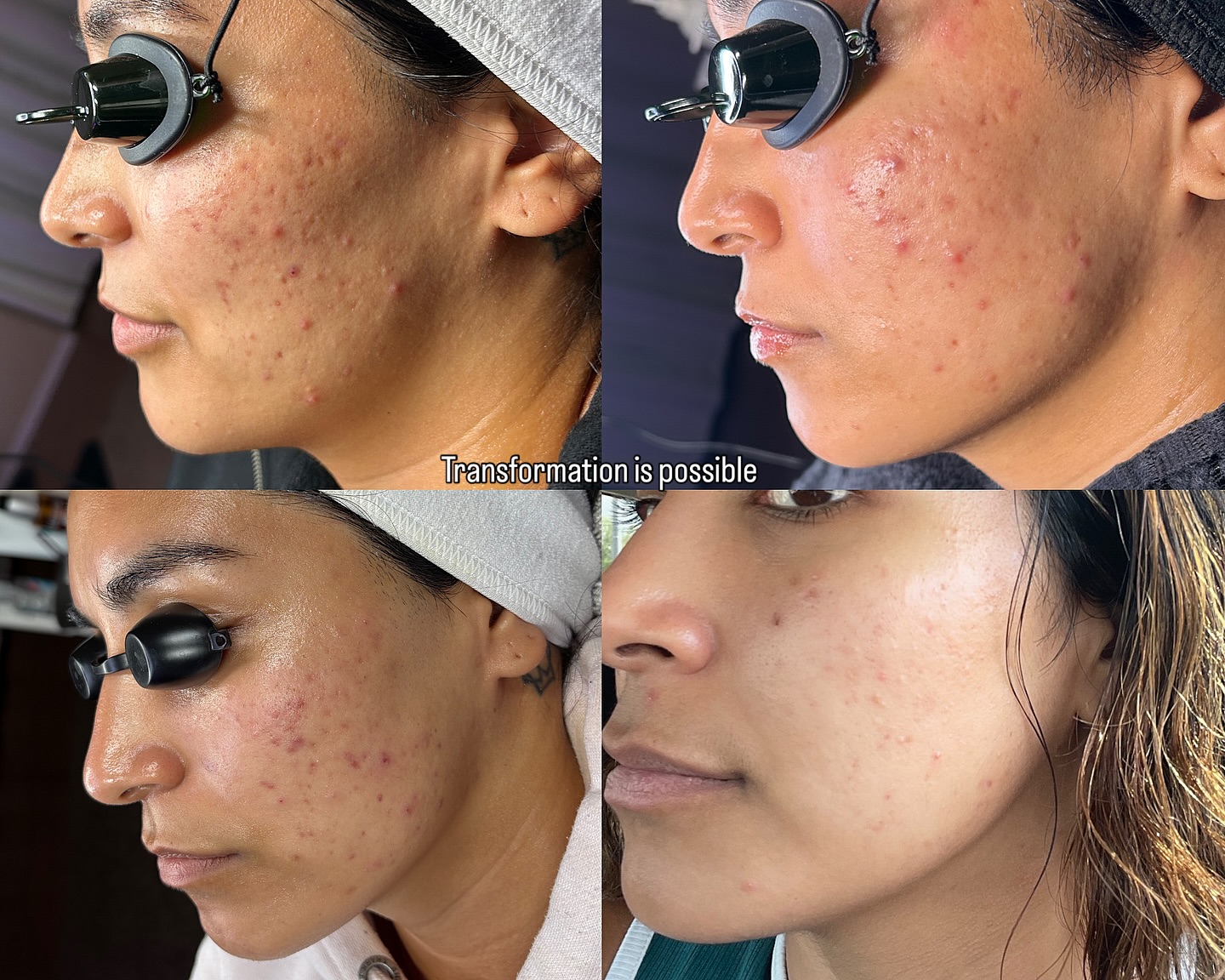 Skin changes when healing begins.
From unsure → consistent → clearer → confident. 🤍🩷
Start your skin journey with me 🫴🏼🩷
#phoenixskincare#phoenixesthetician#azskincare#skintransformation