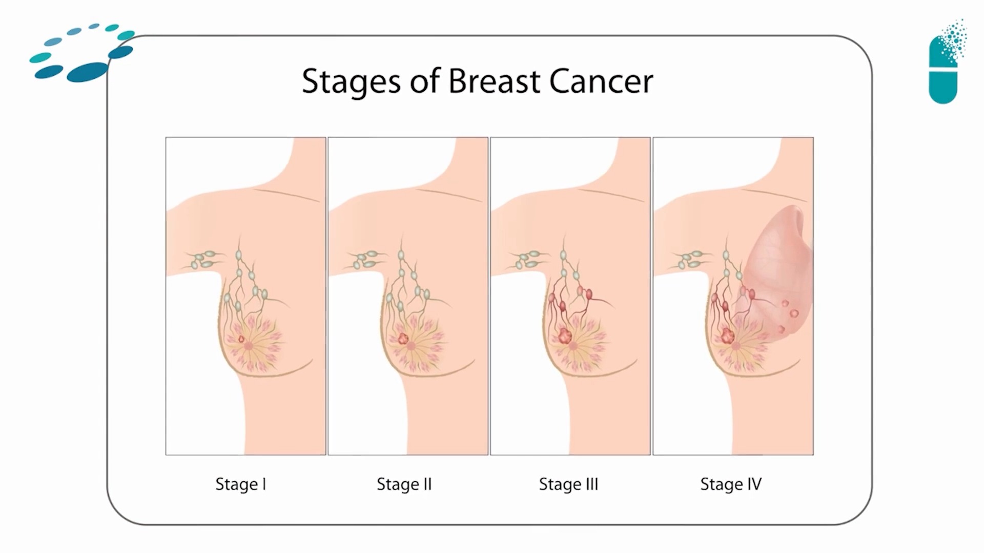மார்பகப் புற்றுநோயின் நிலைகள் பற்றி மருத்துவர் விமலாதித்தன் விளக்கம்
.
.
.
📍 Dr. N. S. Vimalathithan – Surgical Oncologist, Chennai
.
.
.
📞 +91 99628 66666
🌐 www.oncospecialist.com
.
.
.
#BreastCancer #BreastCancerAwareness #CancerAwareness
#Oncology
#CancerCare
#HealthPodcast
#MedicalPodcast
#DoctorTalks
#HealthcareEducation
#ChennaiDoctors
#HealthTamil
#cancerawarenesstamil