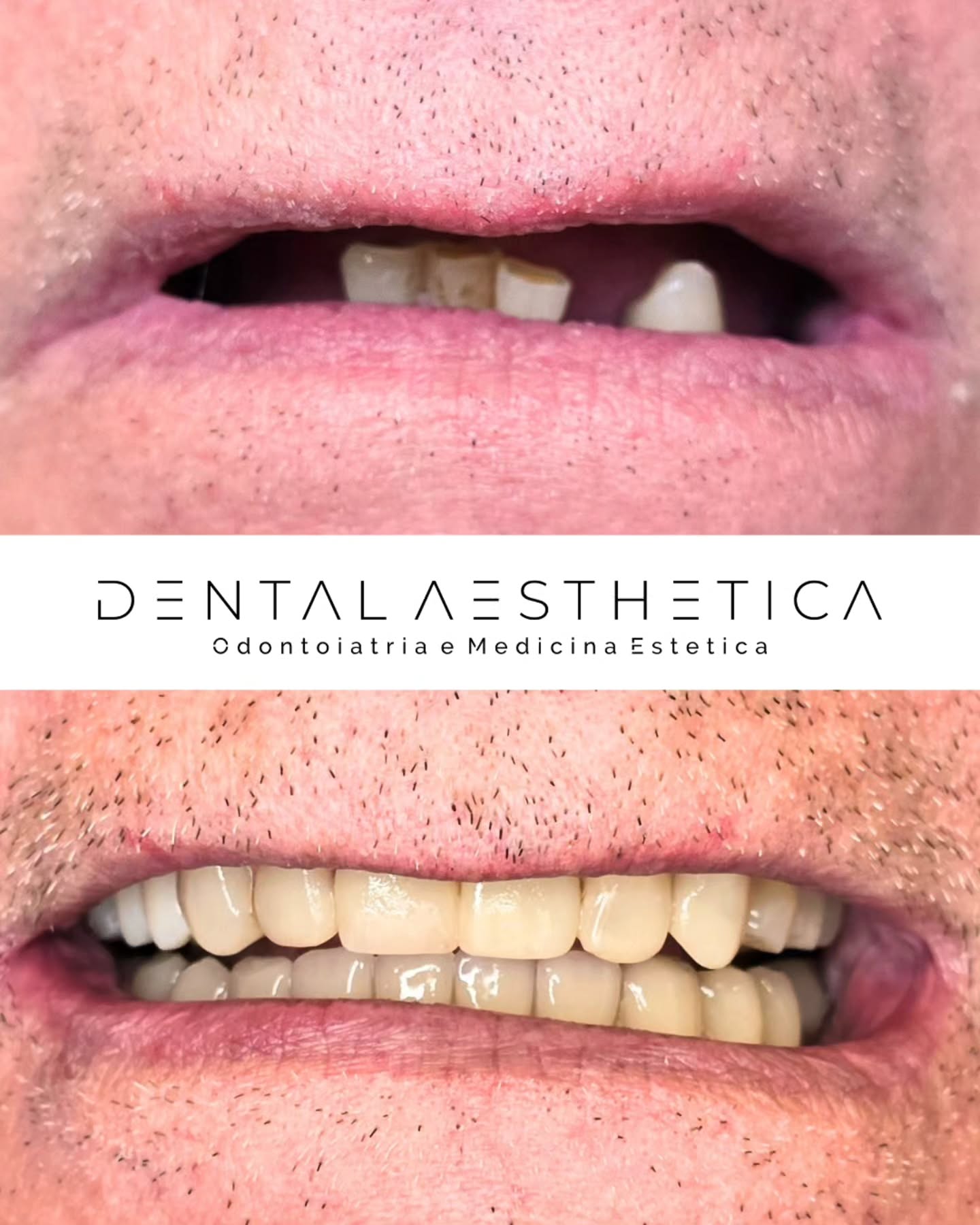Riabilitazione totale doppia arcata.
Terapia ricostruttiva additiva per l'arcata superiore e protesi totale su impianti per l'arcata inferiore.
Risultato?
Funzionalità masticatoria ed estetica totalmente ripristinate.
Good job, @doc_claudiomarinelli
Dental Aesthetica
✨️ Odontoiatria e medicina estetica
📍 viale della Grande Muraglia 256, zona EUR-Torrino
📱 375 88 47 069