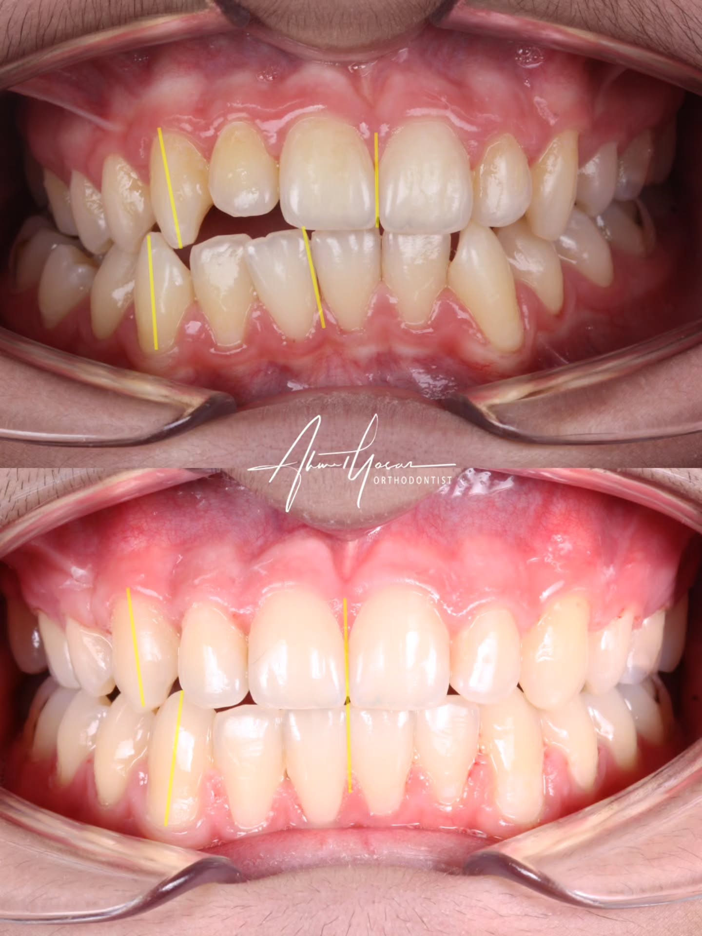 Our clinic is authorized by the Ministry of Health of the Republic of Türkiye for International Health Tourism. All patients have been informed and have provided consent for the use of their photographs on our social media platforms. All content shared on social media is intended to inform patients about procedures and should not be perceived as advertising. Outcomes of any surgical or interventional treatment may vary from person to person. It is recommended to consult your physician for detailed information before undergoing any procedure.
.
.
.
#ortodonti #ortodontist #bursa #bursaortodonti #bursaortodontist #bursaortodontiuzmanı #orthodontics #braces #teltedavisi #dişteli #orthognathicsurgery #invisalign #diş #şeffafplak #lingualortodonti #dişteli #çeneameliyatı #selfligating #kapaklıbraket #gülüştasarımı #dişhekimi #dentistry #photography #estetik #dentalart #ahmetyasar