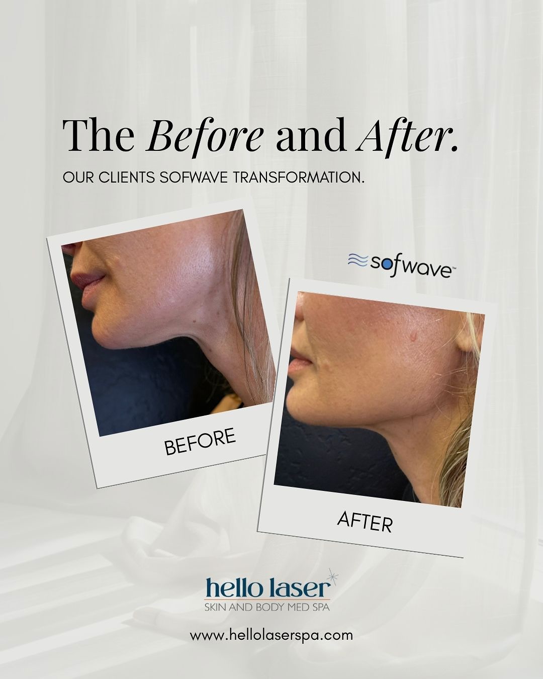 ✨ Sofwave Transformation After Just 1 Treatment! ✨
Forehead 🔥 Jawline 🔥 Under-chin lift 🔥
Our client is already seeing smoother, tighter, more sculpted results and this is only the beginning. Sofwave continues to improve over the next 12 weeks.
Ready for your own lift without downtime?
📍 Only at Scottsdale
📞 480-905-3080
🌐 www.hellolaserspa.com
Book now through our website! Your best skin starts today.
#Sofwave #SofwaveResults #SofwaveBeforeAndAfter #SkinTightening #NonSurgicalLift #JawlineLift #LowerFaceTightening #UnderChinTreatment #ForeheadTreatment #CollagenBoost #ScottsdaleMedspa #ScottsdaleAesthetics #ScottsdaleBeauty #HelloLaser #ScottsdaleSkin #ArizonaMedspa #AZMedspa #ScottsdaleAZ #ScottsdaleWomen #ScottsdaleMoms #SkinClinicAZ #AntiAgingAZ
