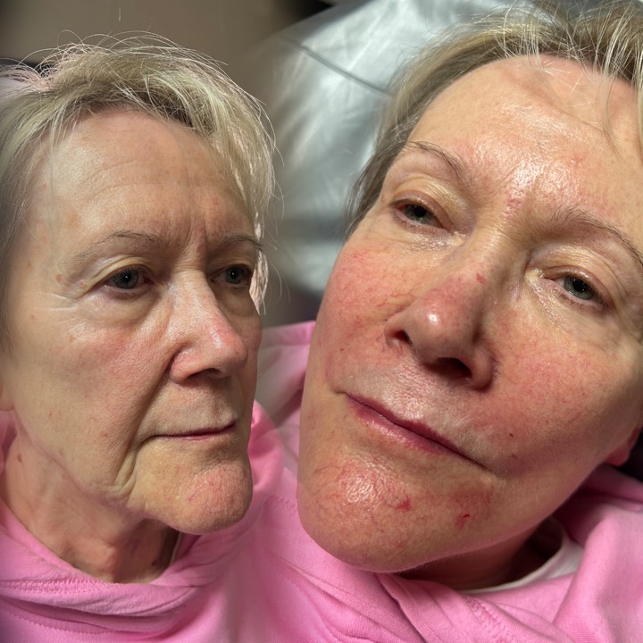 ✨ Isn’t it amazing what a touch of filler can do? ✨
Smooth, lift, refresh — and reveal a younger, more confident you just in time for the Christmas season! 🎄💫
💉 3ml of dermal filler for ONLY £189
at The Beauty Lab North East! 😍
Book in with our Senior Aesthetics Practitioner, Rachel, and let her work her magic. Whether you’re wanting fresher skin, fuller features or a subtle, natural rejuvenation, Rachel is the expert you can trust. 💖
📍 Available at both our Felling & South Shields branches!
Ready to look younger this festive period?
📲 Book your appointment today!
#TheBeautyLabNorthEast #DermalFiller #FillerDeals #AestheticsNorthEast #LipFiller #CheekFiller #JawlineFiller #BeautyClinic #AestheticsPractitioner #YouthfulSkin #ChristmasReady #Felling #SouthShields #NorthEastAesthetics #GlowUp #EnhanceYourBeauty #FestiveGlow #LookYounger #ConfidenceBoost