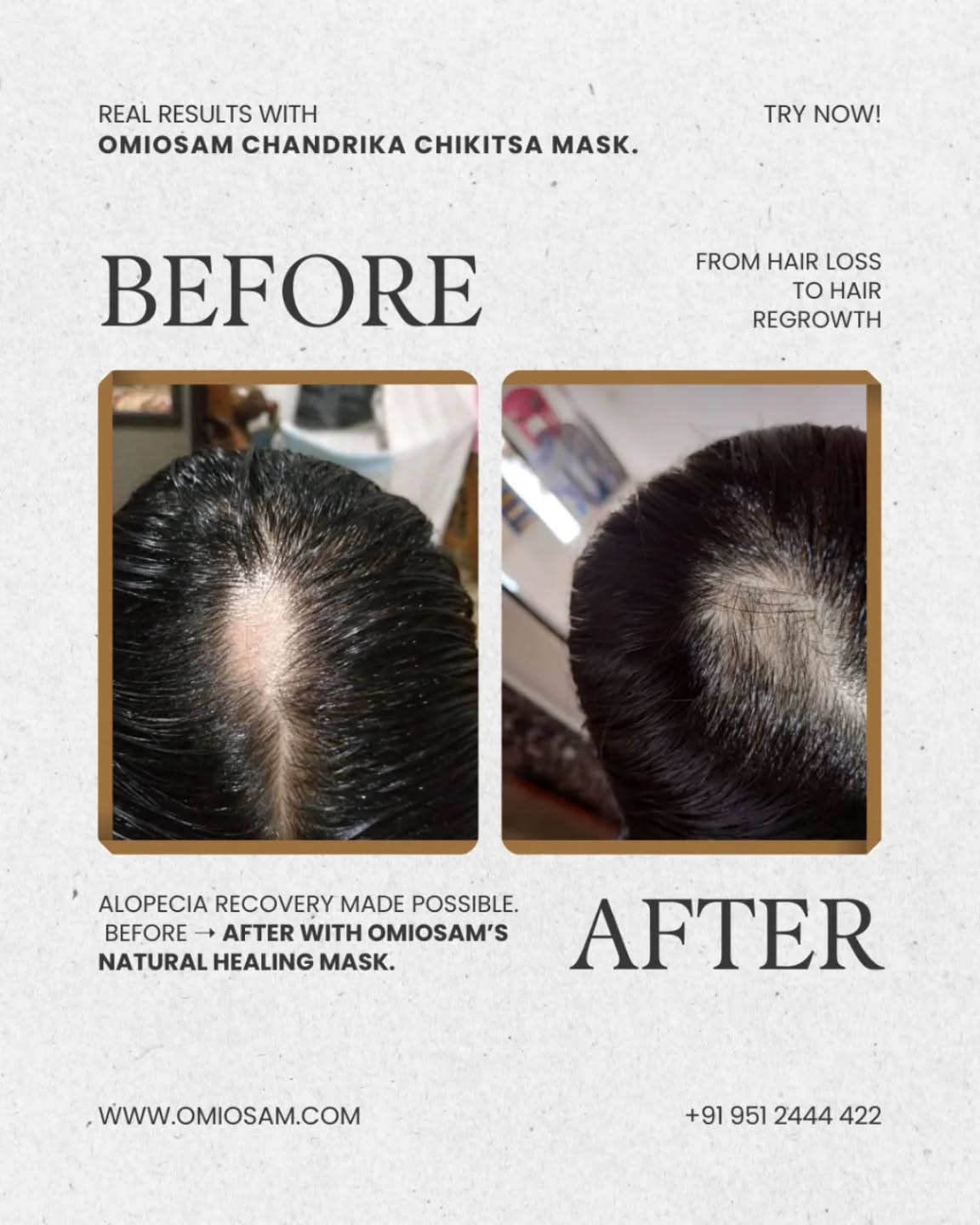 Alopecia Beard Recovery Starts Here.
Natural, visible change with Chandrika Chikitsa Mask.
Shop Now
www.omiosam.com
+91 9512444422
#Omiosam #ChandrikaChikitsaMask #HairAlopecia #HairRegrowth #BeforeAfter NaturalHealing HerbalCare HairCareRoutine AlopeciaResults OmiosamResults
