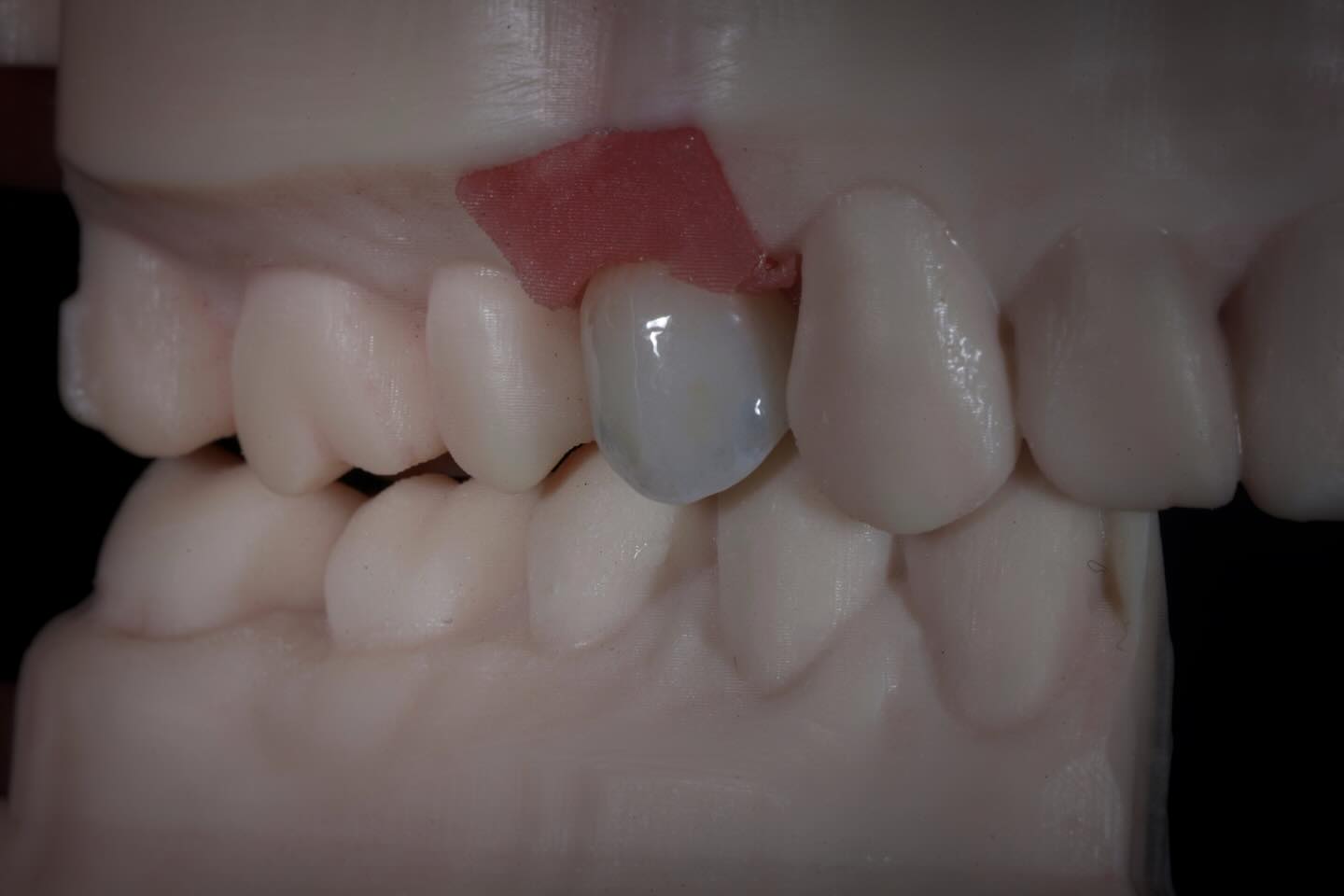 Lisi Emax crown #crownifydentallab #crownify