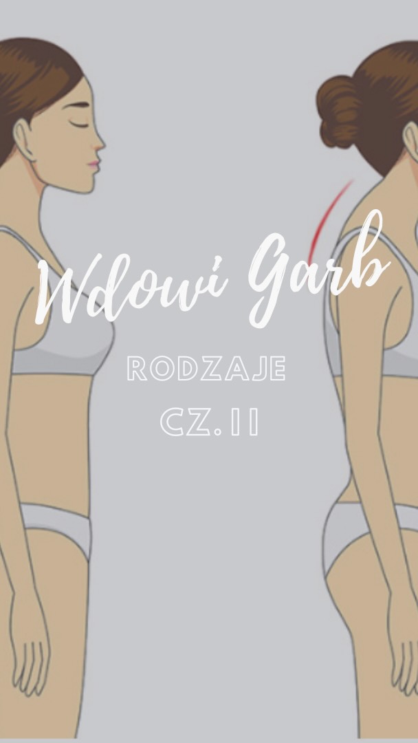 WDOWI GARB PROBLEM XI wieku❌ cz II
Poznaj rodzaje tej przypadłości👇🏼
1. Posturalna hiperkifoza (garb wynikający z postawy)
Najczęstsza forma, związana z siedzącym trybem życia, osłabieniem mięśni międzyłopatkowych i przykurczami klatki piersiowej.
Cechy: zaokrąglone plecy, wysunięta głowa, napięcie karku.
Przykład: osoby pracujące przy komputerze, z długotrwałą pozycją „pochylenia” 🧑💻📱
🔍 Ten typ dobrze reaguje na korekcję postawy, mobilizację odcinka piersiowego i wzmacnianie stabilizacji
2. Dorsocervical fat pad („poduszka tłuszczowa”)
Nagromadzenie tkanki tłuszczowej w okolicy karku. Może występować u osób z otyłością, ale charakterystycznie pojawia się także:
• przy zespole Cushinga,
• podczas długotrwałego stosowania glikokortykosteroidów,
• przy zaburzeniach metabolicznych.
Cechy: miękka, wyczuwalna „poduszka”, która nie wynika z ustawienia kręgosłupa.
🔍 Tu kluczowe jest leczenie przyczynowe – endokrynologiczne lub metaboliczne – a dopiero później praca manualna.
3. Garb osteoporotyczny
Powstaje w wyniku osłabienia struktury kości, prowadzącego do kompresyjnych złamań kręgów piersiowych.
Najczęściej dotyczy osób starszych, szczególnie kobiet po menopauzie.
Cechy: mocno zaokrąglony górny odcinek pleców, ból, stopniowe pogłębianie deformacji.
🔍 Priorytetem jest diagnostyka, leczenie osteoporozy i bezpieczna terapia ukierunkowana na odciążanie kręgosłupa.
⸻
👉 Każdy z tych typów wygląda podobnie, ale wymaga zupełnie innego podejścia.
Program pracy z pacjentem dobierany jest indywidualnie zawsze po przeprowadzeniu wywiadu 📃
💭 Masz pytania? WYŚLIJ WIADOMOŚĆ📩 i dowiedz się więcej! Umówimy się na spotkanie i ustalimy warunki, rozwojowej współpracy :)
Selfcare = Selflove ❤️
Kontakt
📲 451 060 072
👩🏼💻 studiobalans.booksy.com
👩🏼💻 studiobalans-niepolomice.pl
📍 Ul. 3 Maja 13 Niepołomice
❗️Nr rejestru Instytucji Szkoleniowej : 2.12/00050/2024