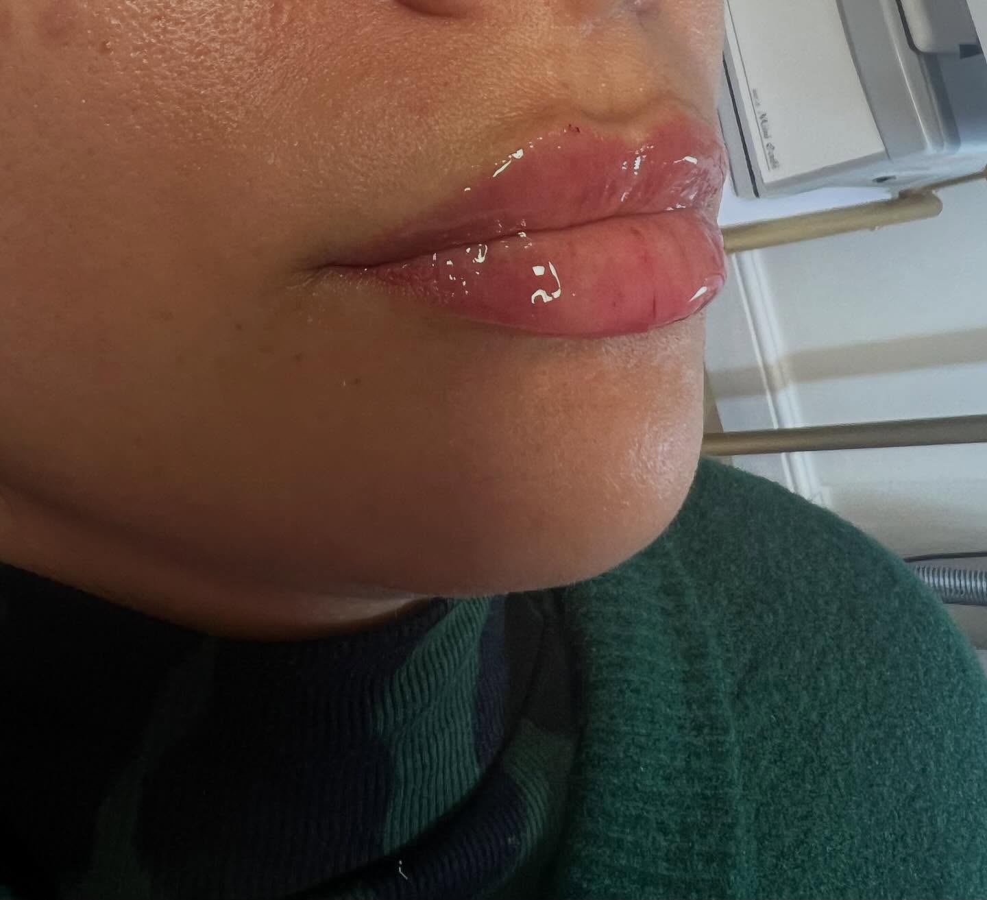 Proof that lip filler doesn’t have to look overdone! Less really is more 👄