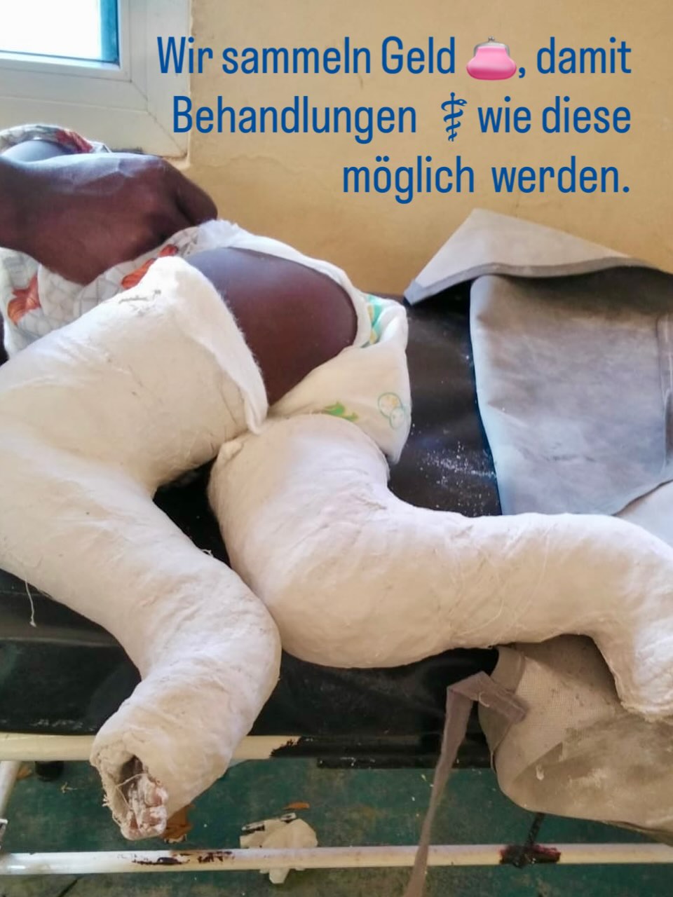 Wir sammeln Geld 👛, damit Behandlungen ⚕️wie diese möglich 🤗werden.
Warum Kinder wie Amina unsere Hilfe brauchen.
Die siebenjährige Amina 🌸 ist von Zerebralparese betroffen und hat zusätzlich Klumpfüsse 🦶.
In unserem Medical Centre erhält sie wöchentlich Physiotherapie 💆♀️. Die Gipsbehandlungen helfen dabei, ihre Füsse Schritt für Schritt in die richtige Position zu bringen 🔄.
Amina hat das Glück, behandelt zu werden 🍀 – doch das gilt leider nicht für viele betroffene Kinder in Kenia. Für viele Familien sind Kinder mit
besonderen Bedürfnissen eine grosse Belastung 😔.
Bei uns in der Tagesklinik fühlen sie sich angenommen und geliebt ❤️. Sie bekommen eine zweite Chance im Leben 🌟.
👉 Diese Kinder brauchen unsere Unterstützung. 🙏
#rheinvalleyhospital #medicalcentre #kenia #medizinischebehandlung #hilfswerk #freiwilligenarbeit #bildung #gesundheit #bildungundgesundheit #gesundheitundbildung #inkubator #fruehchen #baby #kindheit #childhood
#majimoto #medicalcentre #matuga #therapieraeume#rheinvalleymedicalcentre