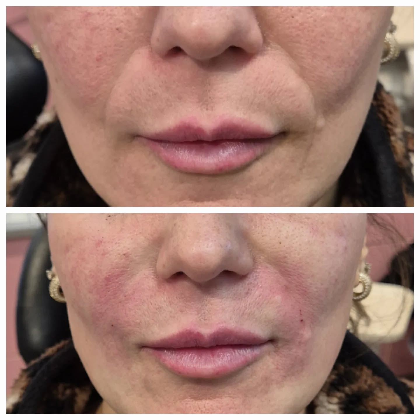 Nasolabial line softening ✨
Designed to restore support, smooth deep folds and refresh the lower face while keeping results natural and balanced. This treatment focuses on facial structure rather than overfilling, enhancing harmony and preserving expression.
Subtle, tailored, and always patient-led. Consultation required. Results vary.