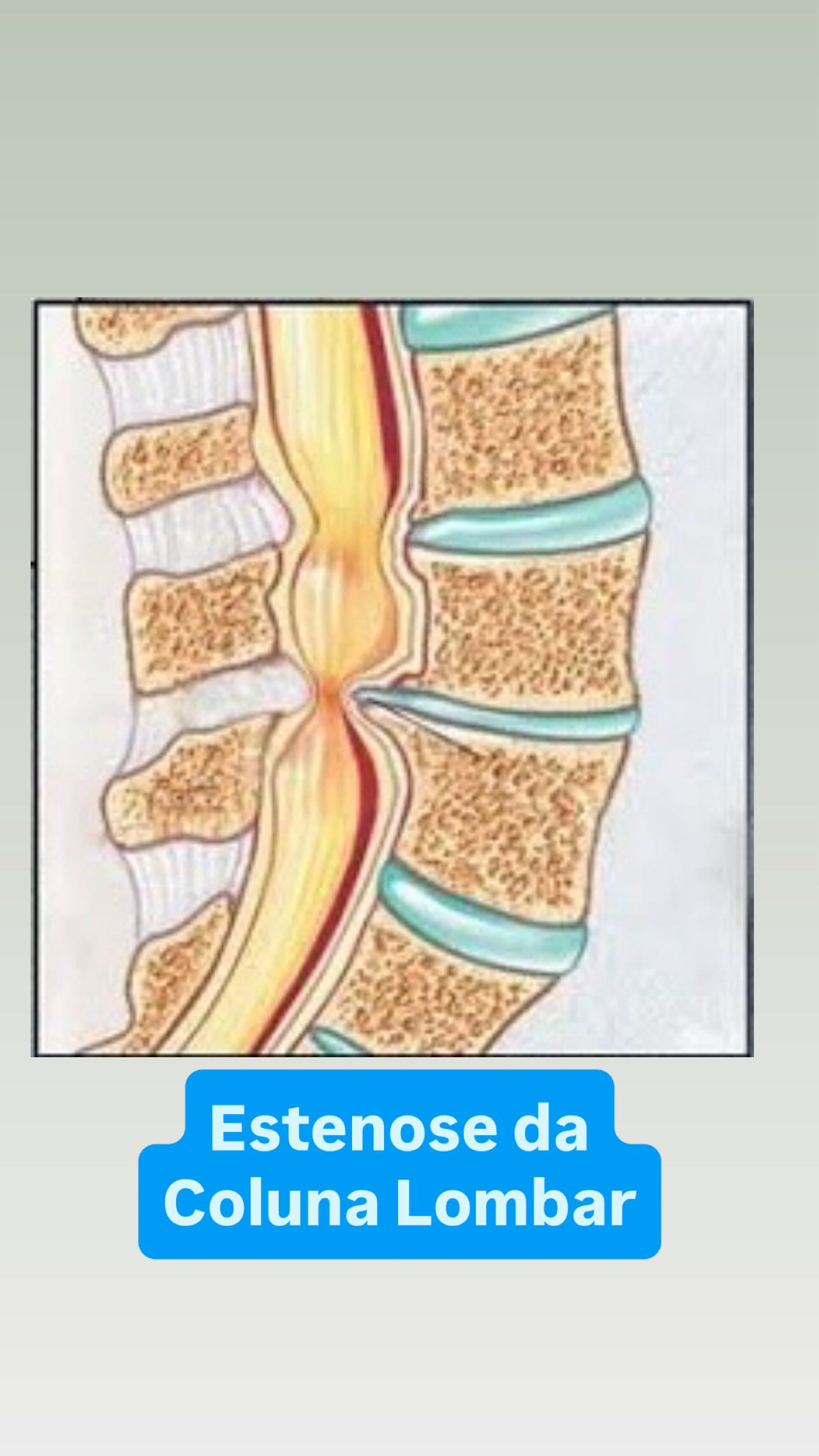 A estenose do canal vertebral, popularmente conhecida como “medula apertada”, ocorre quando há um estreitamento do canal medular, reduzindo o espaço por onde passam as estruturas nervosas da coluna.
Essa compressão pode causar peso nas pernas, formigamento, dor ciática e, em casos mais avançados, dificuldade para caminhar.
A causa mais comum é degenerativa, secundária ao processo de artrose/desgaste da coluna lombar.
Nos estágios iniciais, o tratamento costuma ser conservador, com reabilitação muscular, fisioterapia, pilates e fortalecimento.
Já nos casos mais severos, o tratamento cirúrgico pode ser necessário.
Hoje realizamos a grande maioria dos tratamentos cirúrgicos através de técnicas minimamente invasivas ou endoscópicas, que permitem descompressões completas, incisões pequenas e recuperação muito mais rápida e segura para o paciente.
👉 Se você sente dor ou peso nas pernas ao caminhar, procure avaliação médica. O diagnóstico precoce faz toda a diferença.
#ortopedia #colunavertebral #coluna #dor #medicina