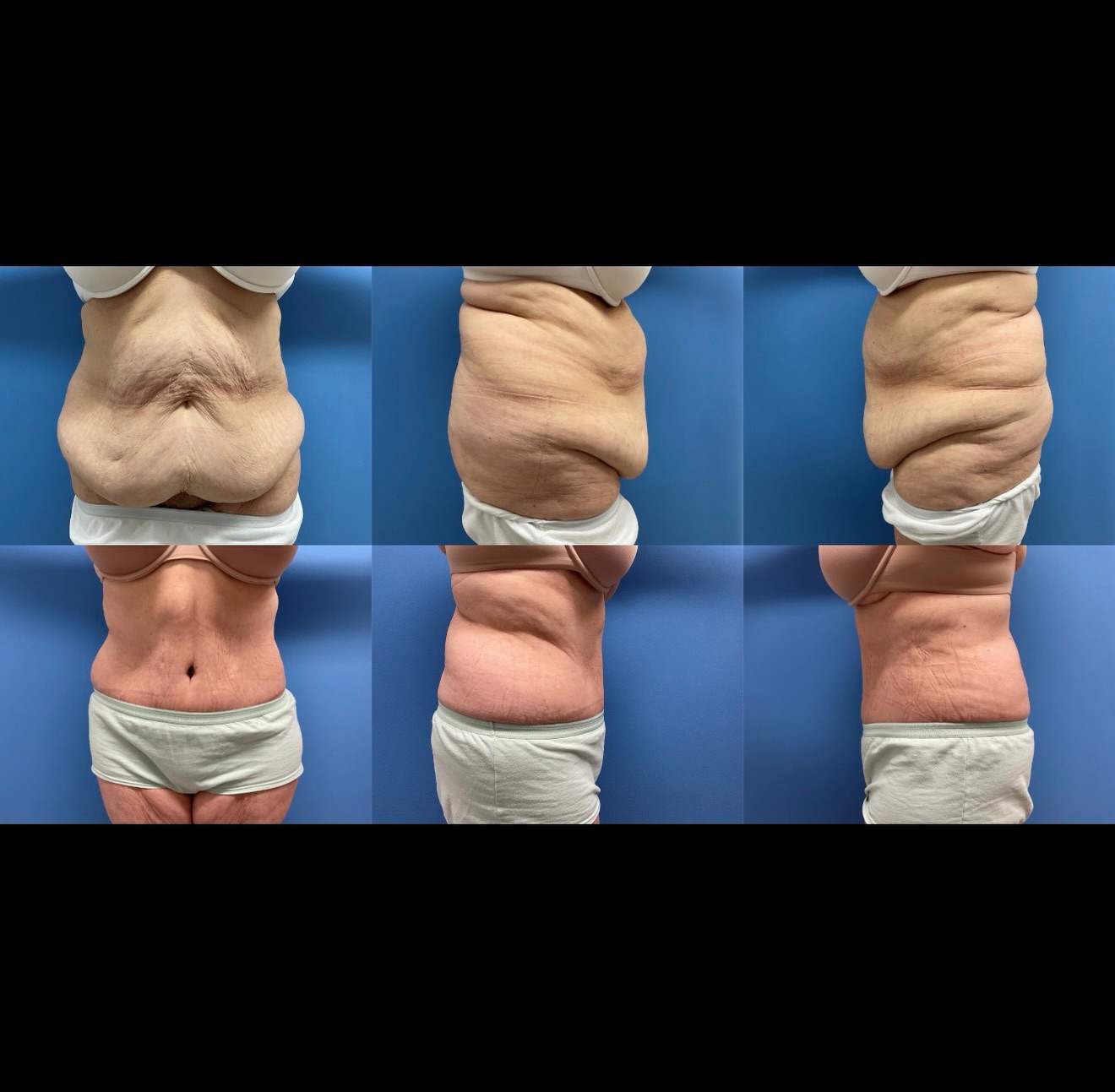 This beautiful patient is feeling more confident after her tummy tuck ✨
A flatter, smoother midsection can be truly life-changing.
🎁 Holiday Special: Enjoy $500 OFF any surgical procedure for a limited time.
Now is the perfect season to invest in yourself and step into the new year feeling your best.
📞 Schedule your consultation today 808-524-1551
.
.
.
#HawaiiPlasticSurgery #BoardCertifiedSurgeon #AestheticEnhancement #NaturalLookingResults #Drbenchu