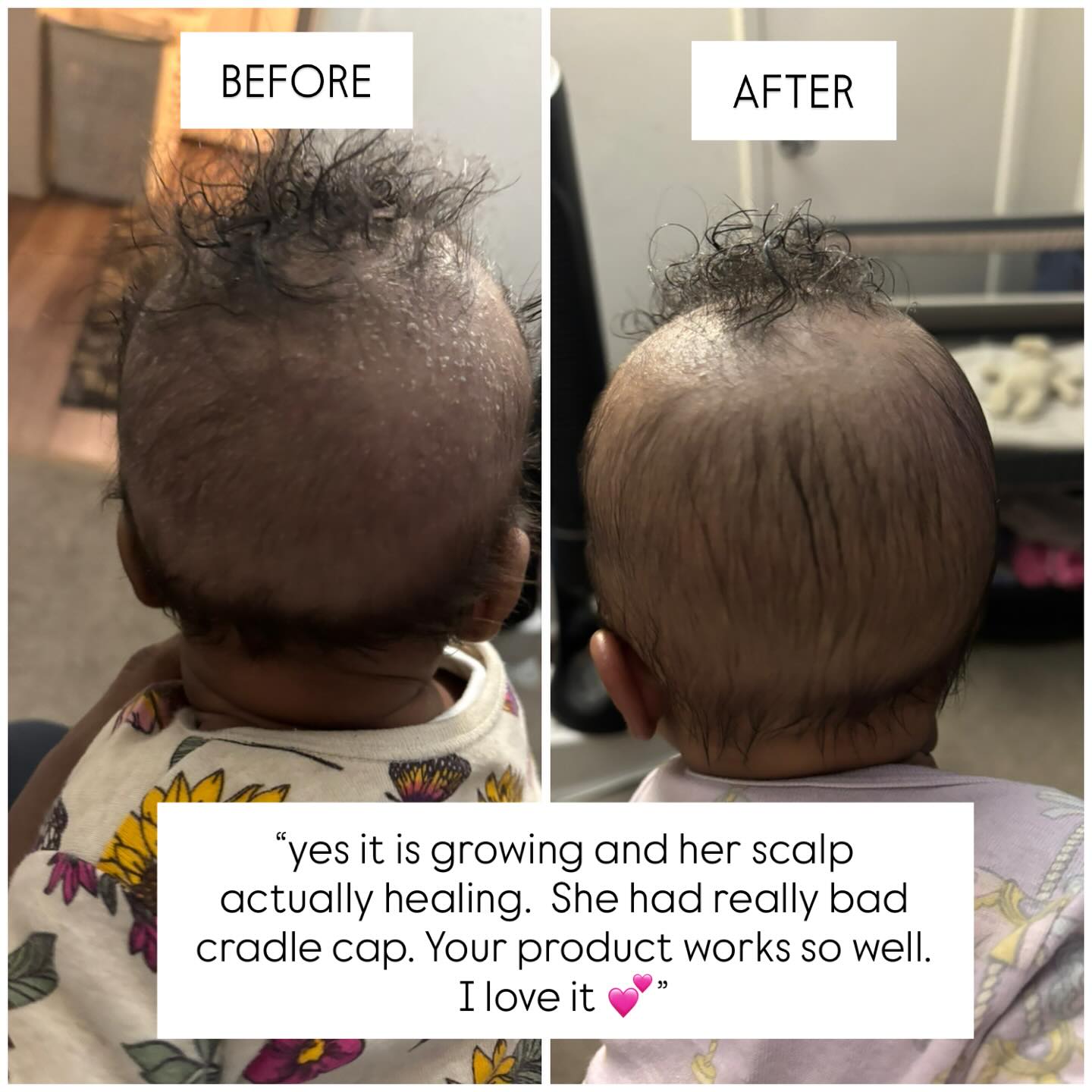 Does your baby suffer from cradle cap, dry scalp or hair loss? Want to stay away from harsh topical treatments? Try our HONEY or ELIXIR!
When we make our products we keep the babies in mind because they need the good stuff too!
Make the switch today and join our family!
Link in bio