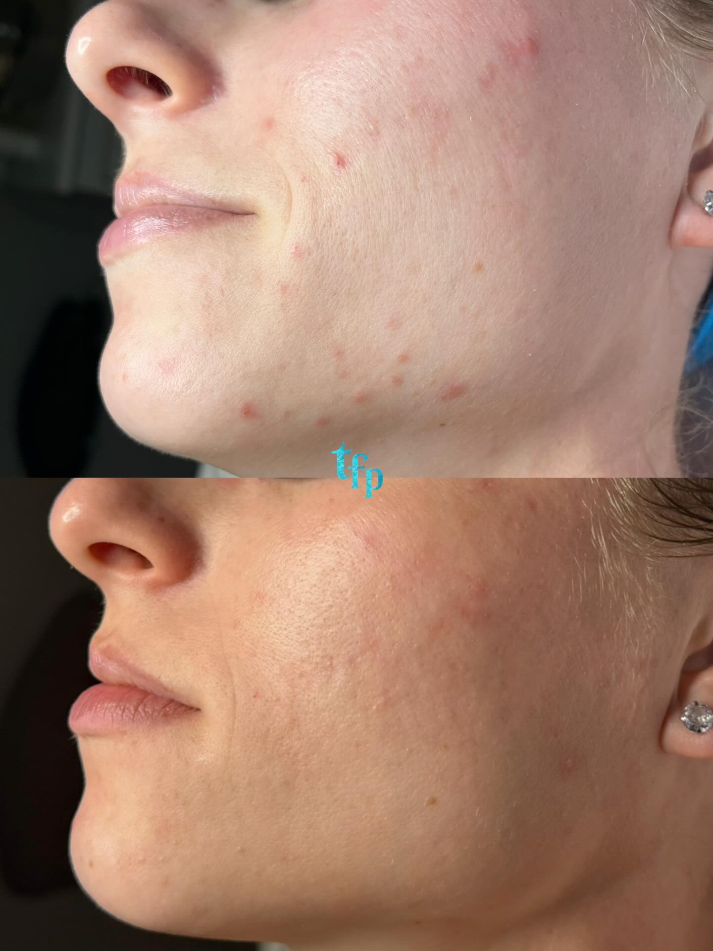 Did you know that even if you’re pregnant you can still do Acne Bootcamp and get Acne facials?!🩵 We will just skip high frequency during your facials (this is only 2-3 mins of the facial) and avoid Vitamin A and chemical SPF in your home care routine ( but you can still use acne gel and clear confidence!). We always will discuss realistic expectations with you since prenatals can trigger some breakouts plus pregnancy nausea and cravings can throw the acne - safe diet out the window, so you may not get 100% percent clear but we can definitely make improvements!!!
I’ve been able to help a lot of pregnant clients maintain and clear their skin, and it’s such a fun journey!🩷
#pregnancy#acnepregnant#pregnantacne#pregnancysafeacne#acnetransformation#acnespecialist#acnespecialistmichigan#acnespecalistdetroit#acnemichigan#acnedetroit
