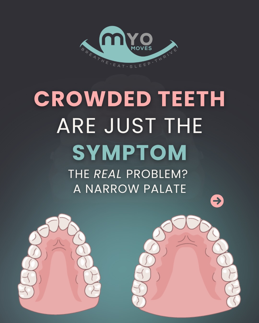 Palatal expansion is often thought of as a way to “make room for teeth.” But the truth is the shape of the palate affects far more than a smile!
A narrow palate can impact:
✅ Nasal vs. mouth breathing
✅ Tongue posture and resting position
✅ Airway size and sleep quality (snoring, restless sleep)
✅ Chronic congestion, allergies, or sinus issues
✅ Overall facial growth and posture
A healthy, wide palate supports proper breathing, tongue-to-palate rest, better airflow, and more restorative sleep.
Swipe to see the difference between a narrow vs. healthy palate, common myths about expansion, and what expansion really does.
💬 Wondering if expansion might be right for you or your child? Comment “expand me” and let’s talk. 👅✨