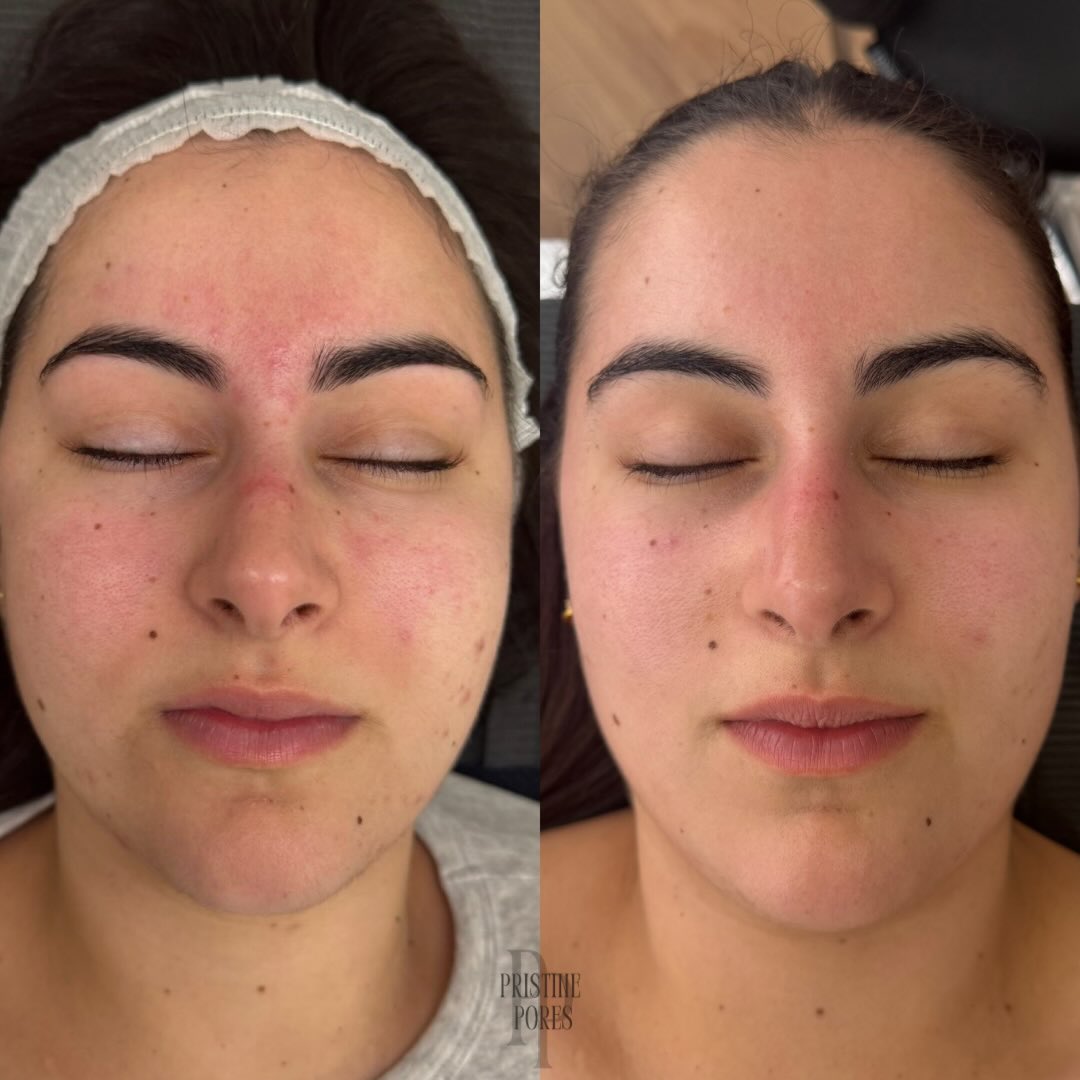 Same skin, different chapter.
We’re halfway through our treatment plan, focusing on barrier repair, calming redness, healing acne and scarring.
Proof that consistency and patience is key. We don’t believe in quick fixes here.
My client came to me a few months ago, we discussed her primary and secondary concerns. Altered her skincare and now we are here 🥹🤍
📆 Start your journey to clear skin today & let’s glow up your skin, the pro way 🪄✨
📍524 Glenferrie Rd, Hawthorn
📞 0466 034 938
🖥️ www.pristinepores.com.au
•
•
•
•
#skin #skintransformation #skinclinic #melbourne #pristinepores