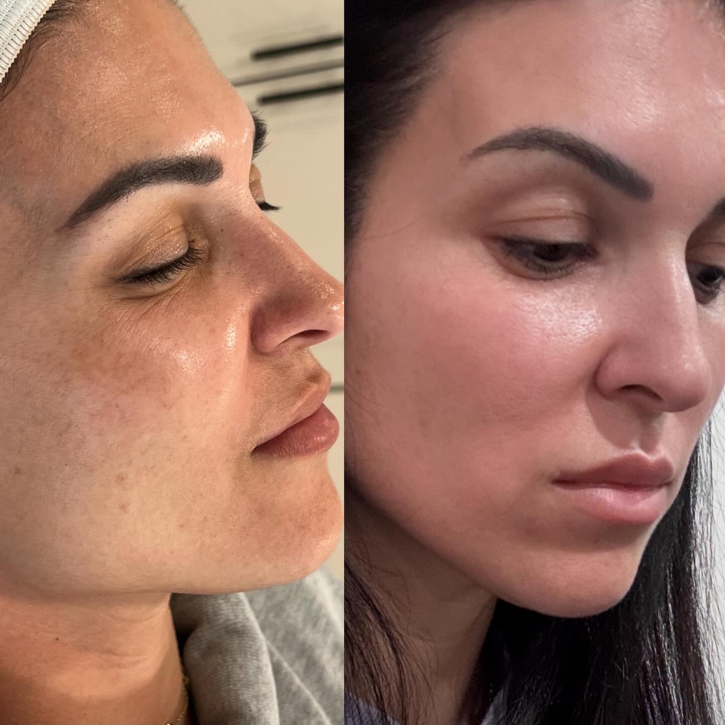 28 days to a new FACE 🤯
The Enlighten Peel is a powerful, prescription-strength chemical peel system designed to treat stubborn skin discoloration like melasma, sun spots, and acne scars by inhibiting melanin production and increasing skin cell turnover, REVEALing brighter, more even-toned skin.
It’s a multi-step process involving an in-office application, followed by a crucial 4-week at-home depigmentation and soothing regimen, making it effective for all skin types and tones that haven’t responded to other treatments.
💫All Skin Tones: Safe and effective for darker skin tones, which often struggle with pigmentation.
💫Expect redness, dryness, and peeling for about a week, requiring commitment to the aftercare.
@revepeel_reveskin
P.S that’s my beautiful sister😍
#enlightenpeel#reveskin
#revepeel#hq#melasma