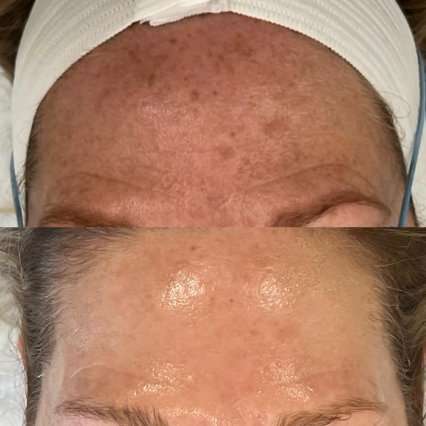 P H O T O F A C I A L
IPL (Intense Pulsed Light) isn’t a true laser but a gentler, multi-wavelength light therapy for skin redness and sun spots.
Delivers a broad spectrum of light (not a single laser beam) in pulses, treating multiple skin issues simultaneously.
Gentler Option: Less focused than lasers, making it good for surface-level concerns and versatile.
#ipl#lasertechnician#sundamage#lumecca#inmode#brokencaps#rosacea