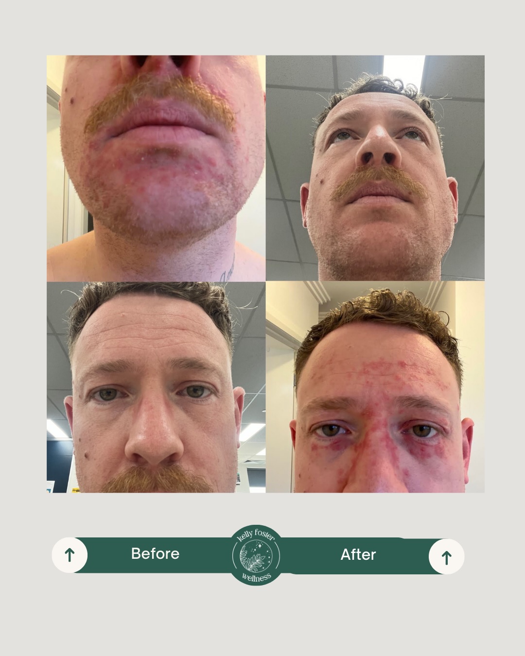 Client success story 🙌
I love how quickly this client saw results once we actually addressed the root cause.
Inflammatory acne + rosacea can be a relentless combo of flushing, redness and sore breakouts. The biggest shift happens when we calm the drivers underneath the skin.
Before → After: reduced redness, reduced reactivity, calmer skin.
What we focused on:
* Reduced vasodilation (less flushing)
* Regulated immune response + lowered systemic inflammation
* Nervous system regulation (less stress reactivity)
* Gut support (gut–skin axis)
* Barrier-friendly, microbiome-safe skincare
If your skin feels “stuck” in inflammation, this whole-body approach can be the missing link ‼️
#rosacea #inflammatoryacne #skinbarrier #gutskinaxis #acupuncture