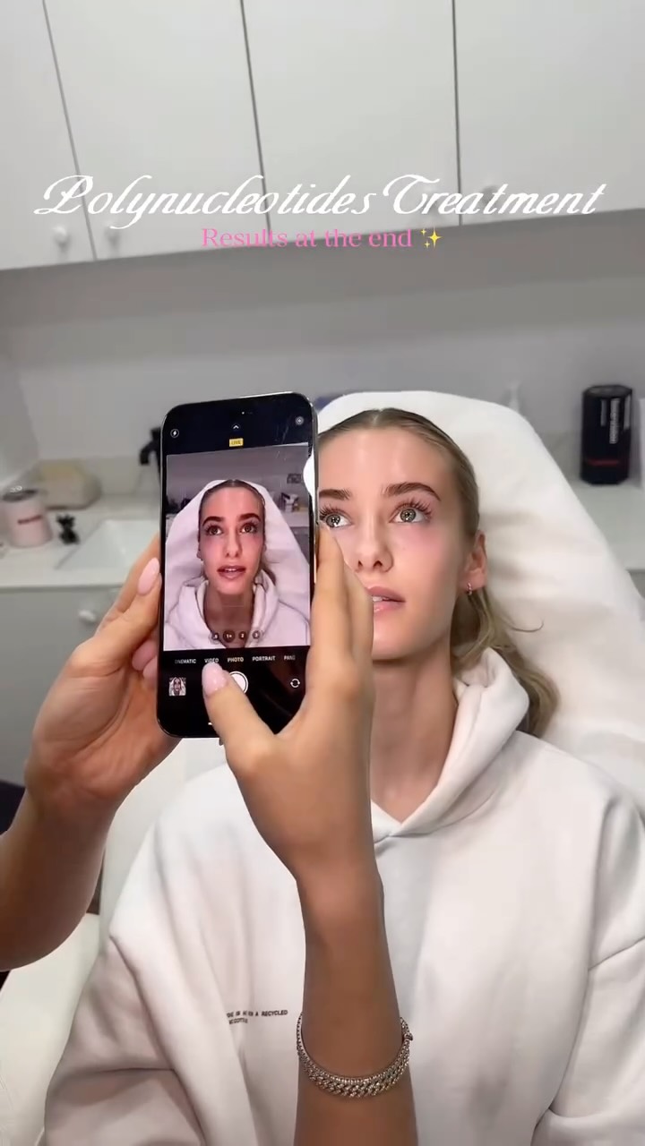 Before and after of 3 sessions using polynucleotides 🥰
#darkundereyes #polynucleotides #aestheticslondon